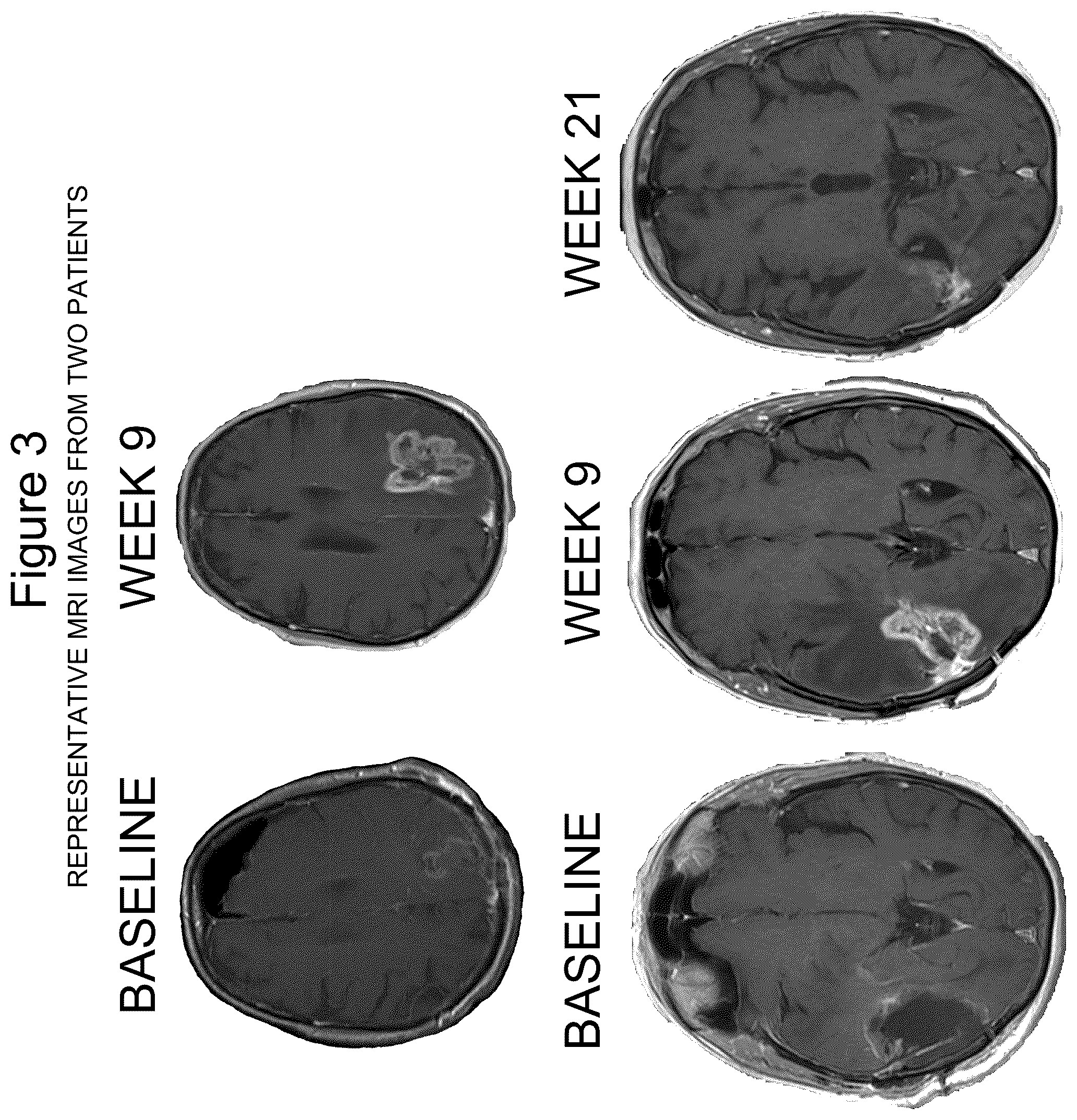 Patent US12350318 Figure 4 – Combination therapy to treat brain cancer
