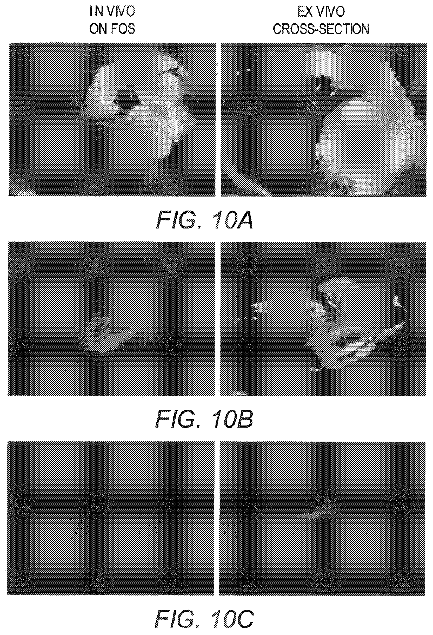Patent US12350341 Figure 8 – Methods for the treatment of cancer and benign lesions by ablation