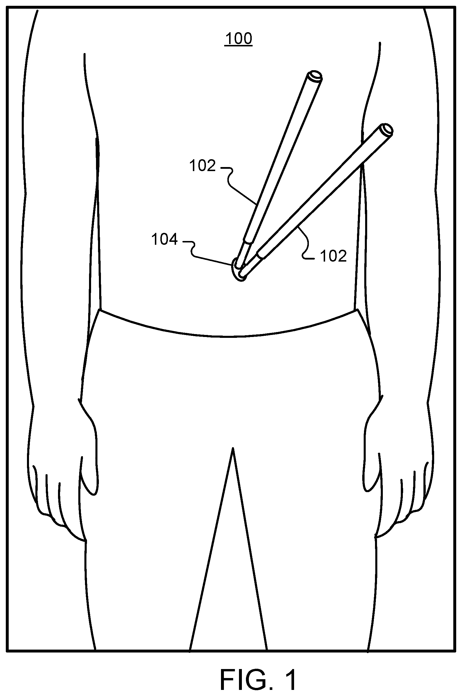Patent US12350396 Figure 1 – Composite positive and negative Poisson's ratio tissue adhesives