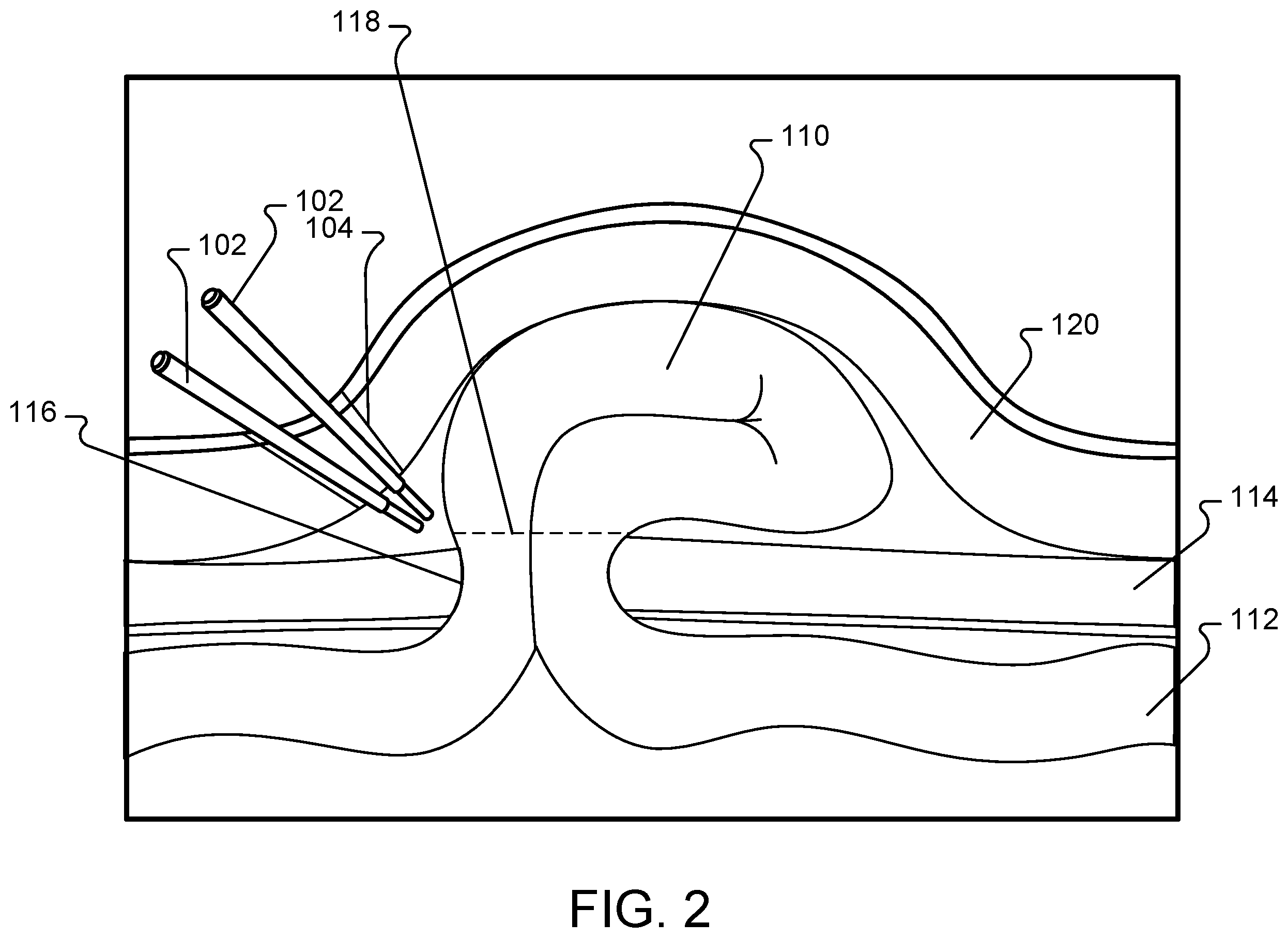 Patent US12350396 Figure 2 – Composite positive and negative Poisson's ratio tissue adhesives