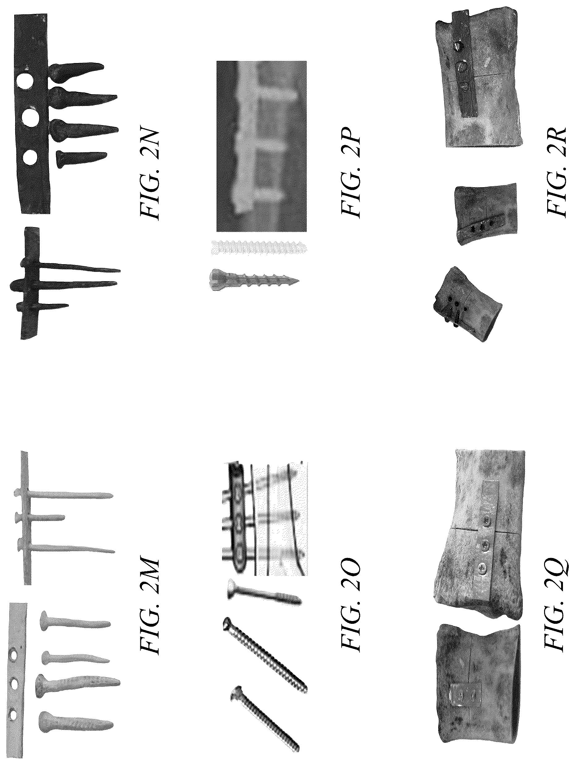 Patent US12350400 Figure 4 – Biodegradable nanocomposite surgical screw containing bone nanoparticles