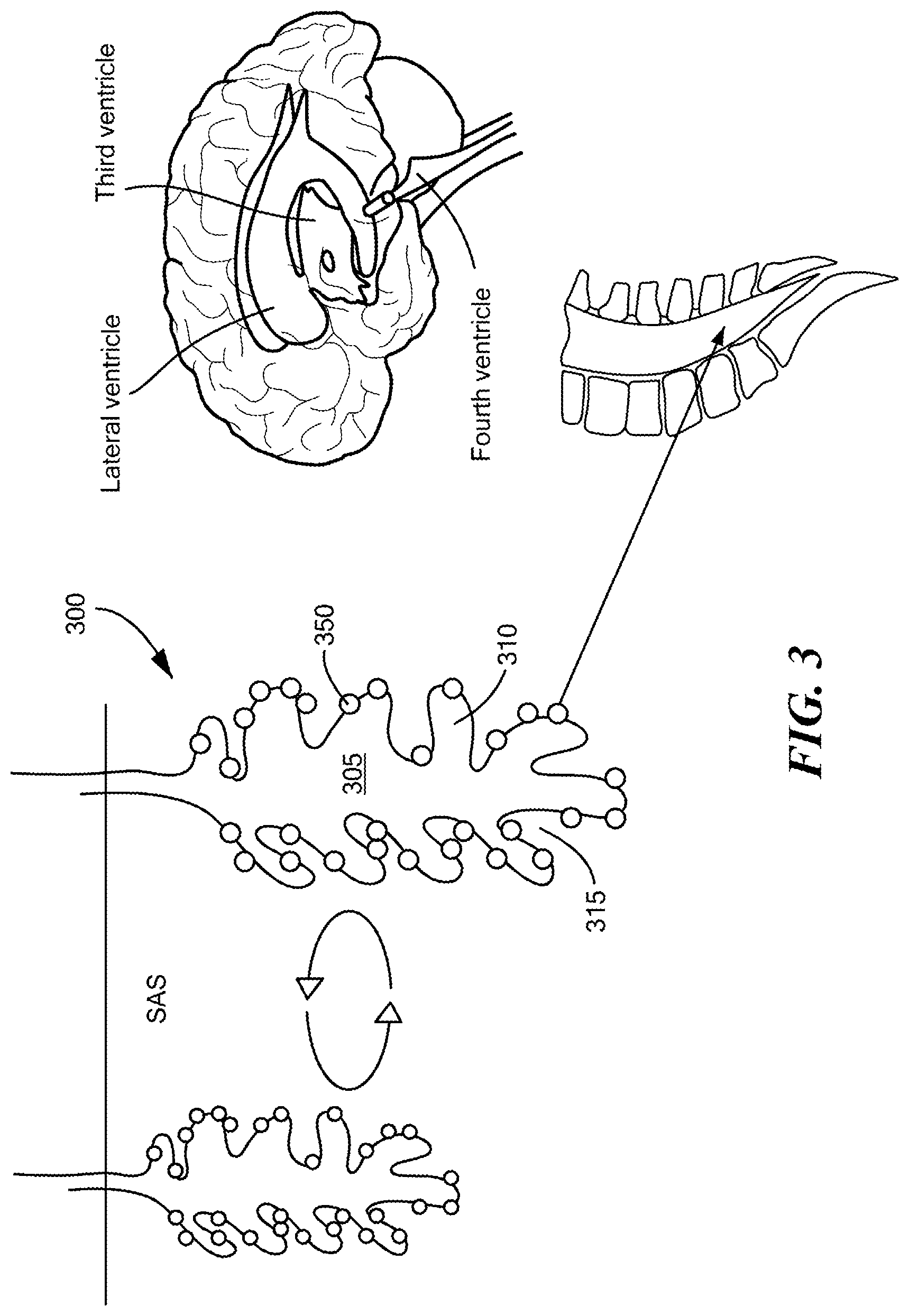 Patent US12350416 Figure 3 – Methods of amelioration of cerebrospinal fluid and devices and systems therefor
