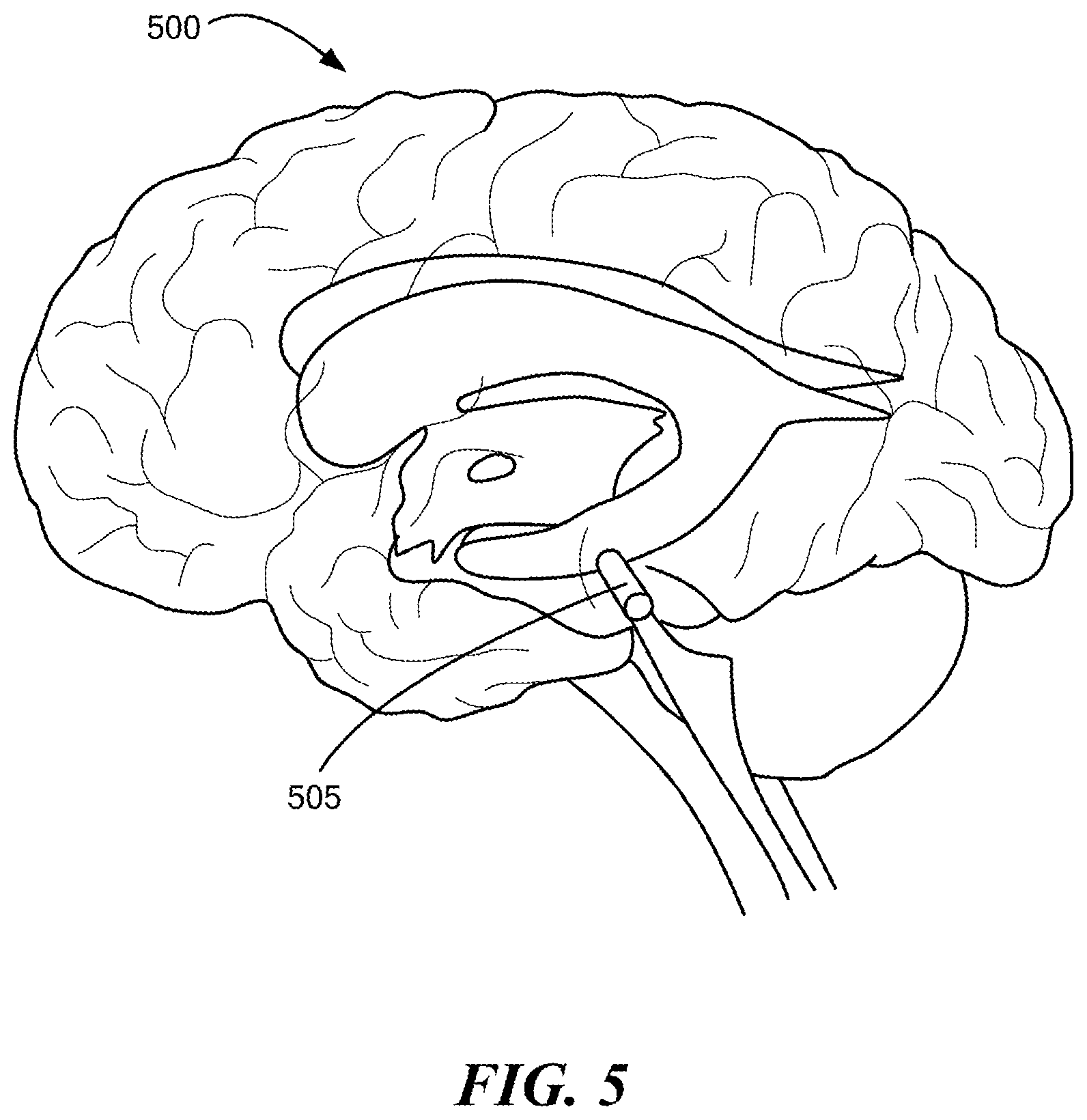 Patent US12350416 Figure 5 – Methods of amelioration of cerebrospinal fluid and devices and systems therefor