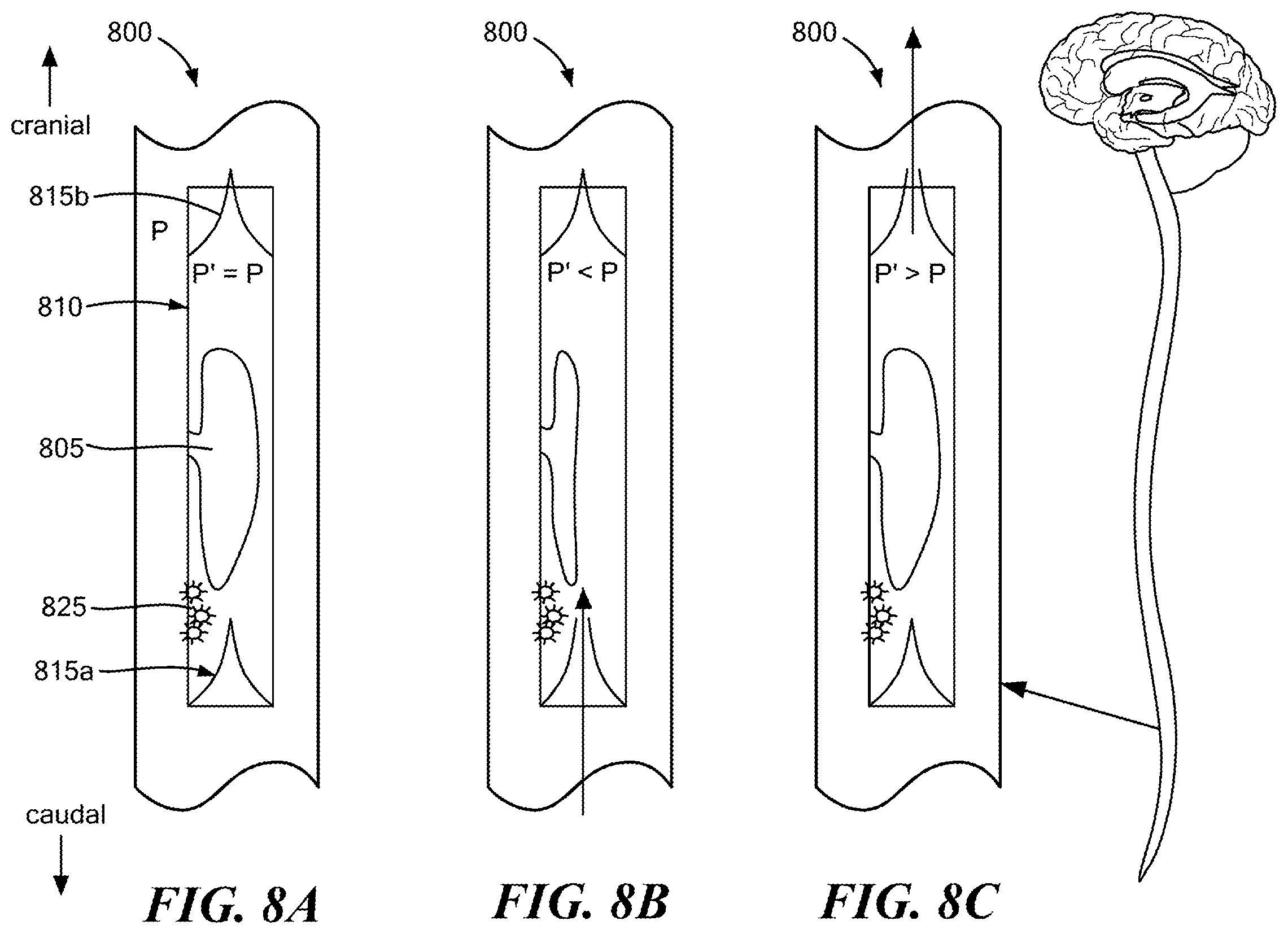 Patent US12350416 Figure 8 – Methods of amelioration of cerebrospinal fluid and devices and systems therefor