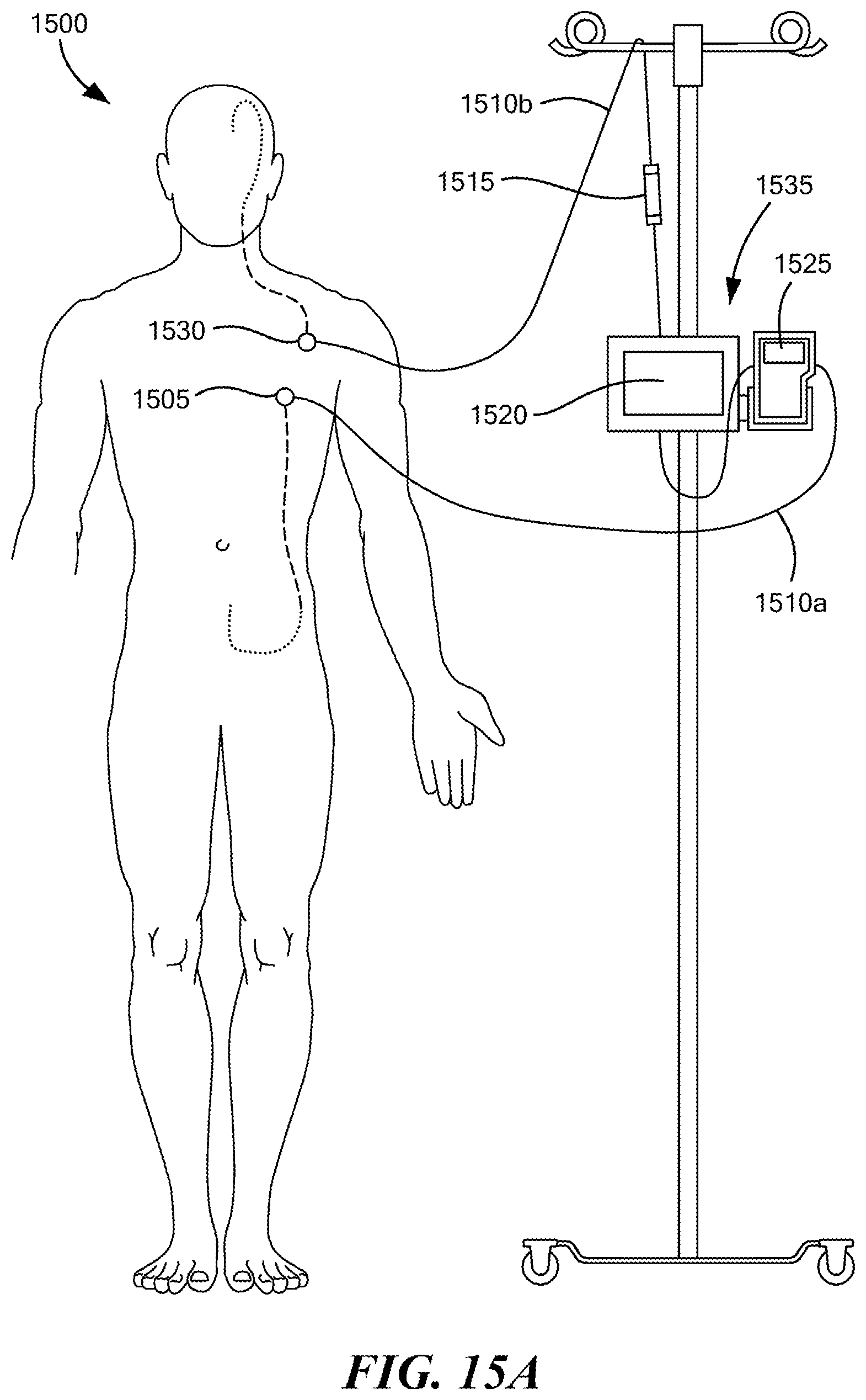 Patent US12350416 Figure 20 – Methods of amelioration of cerebrospinal fluid and devices and systems therefor