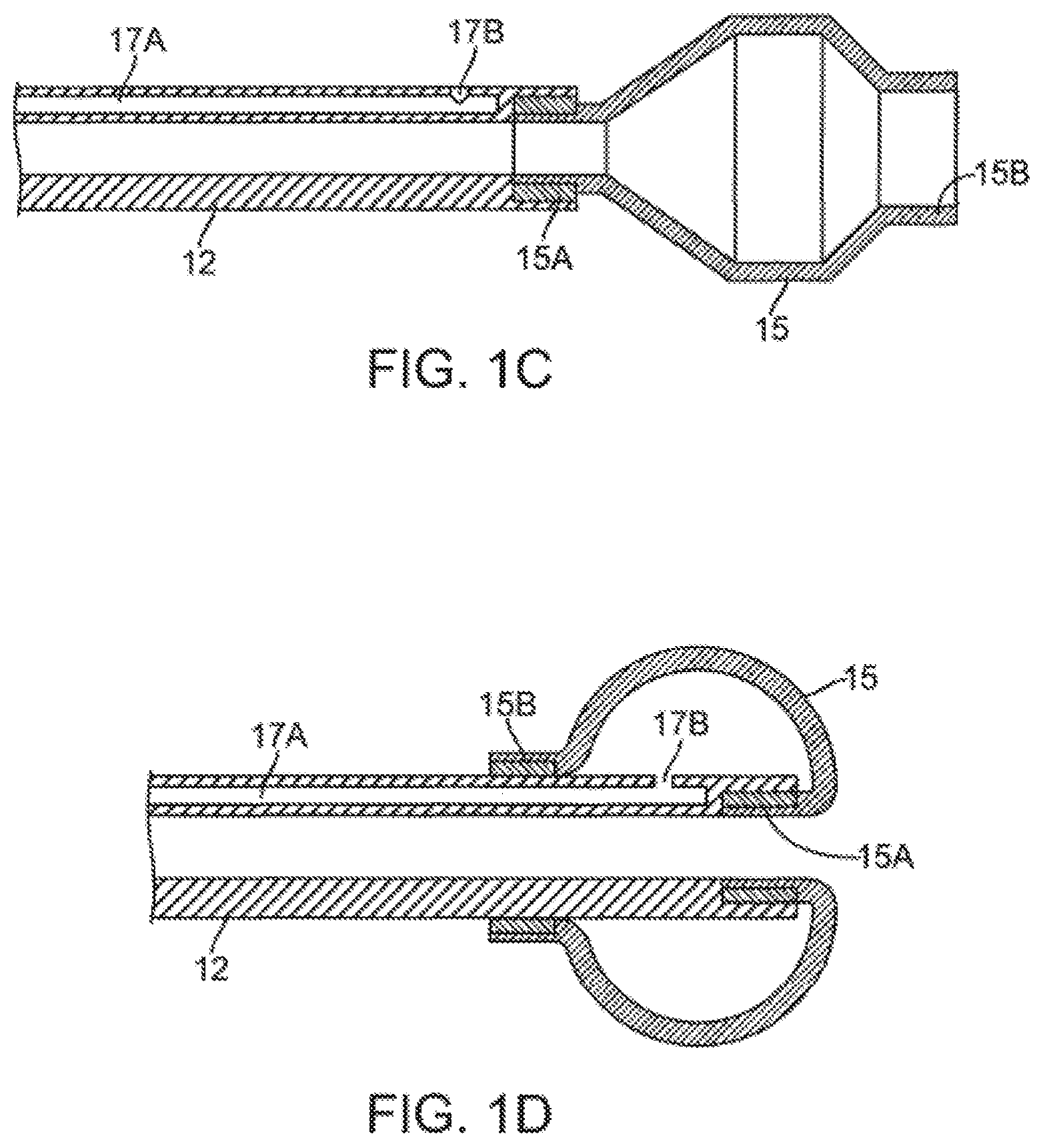 Patent US12350428 Figure 2 – Methods and devices for passive residual lung volume reduction and functional lung volume expansion