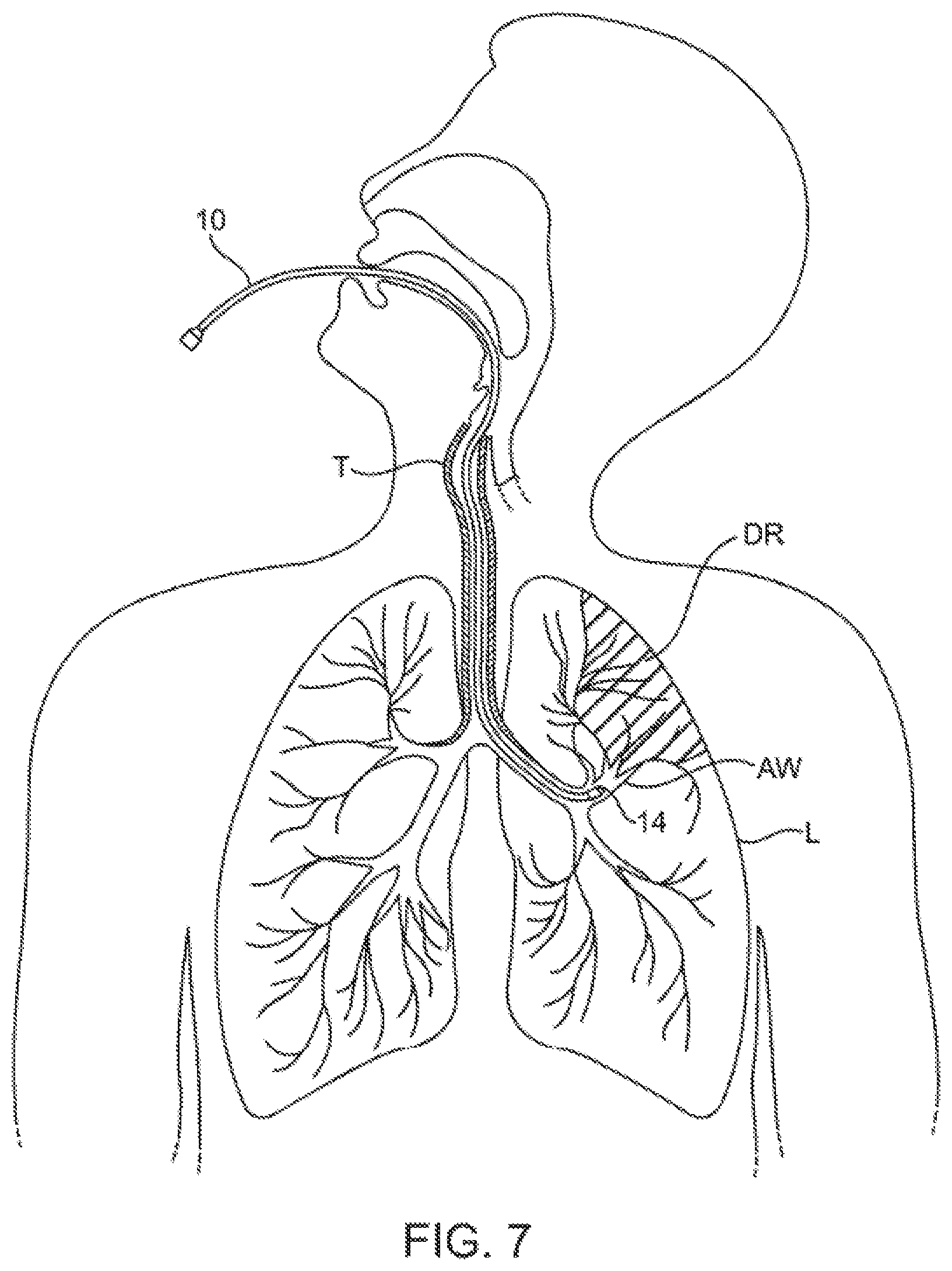 Patent US12350428 Figure 7 – Methods and devices for passive residual lung volume reduction and functional lung volume expansion
