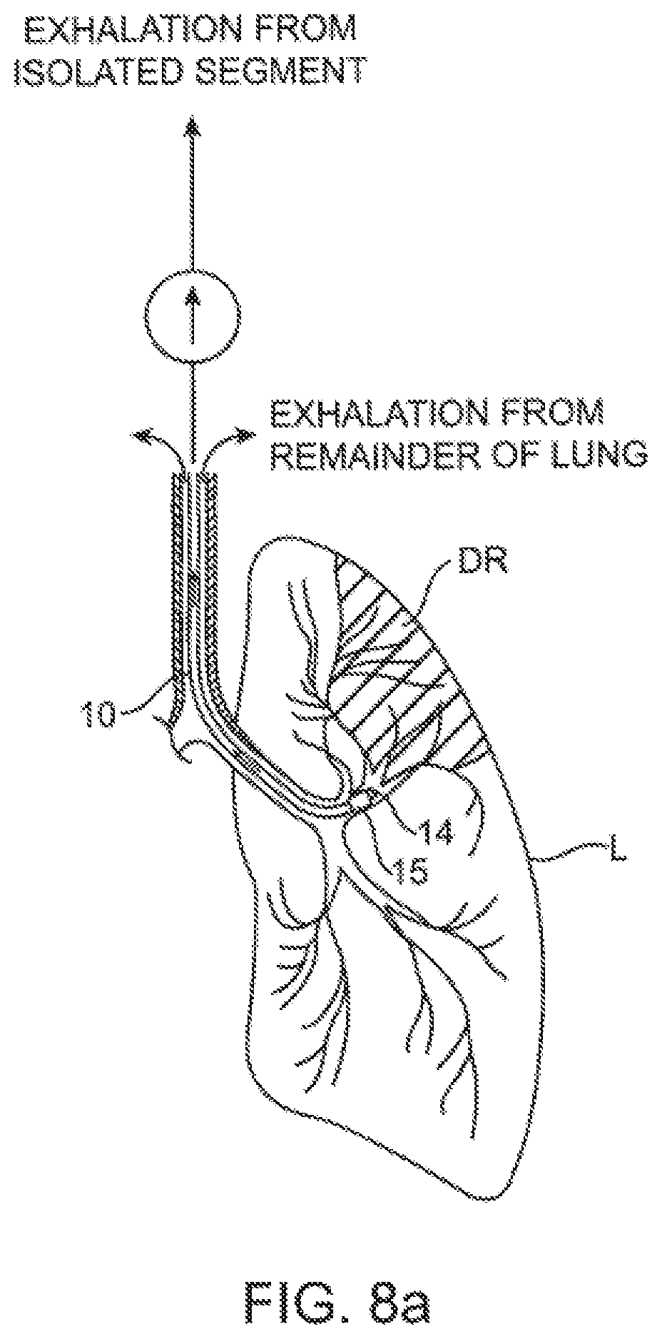 Patent US12350428 Figure 8 – Methods and devices for passive residual lung volume reduction and functional lung volume expansion