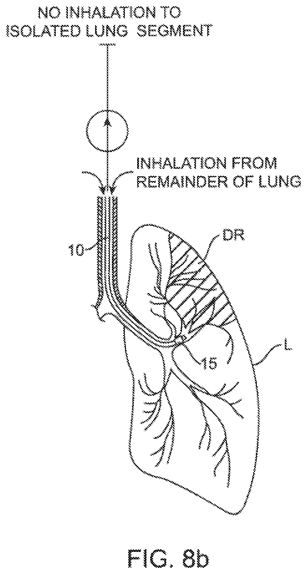 Patent US12350428 Figure 9 – Methods and devices for passive residual lung volume reduction and functional lung volume expansion