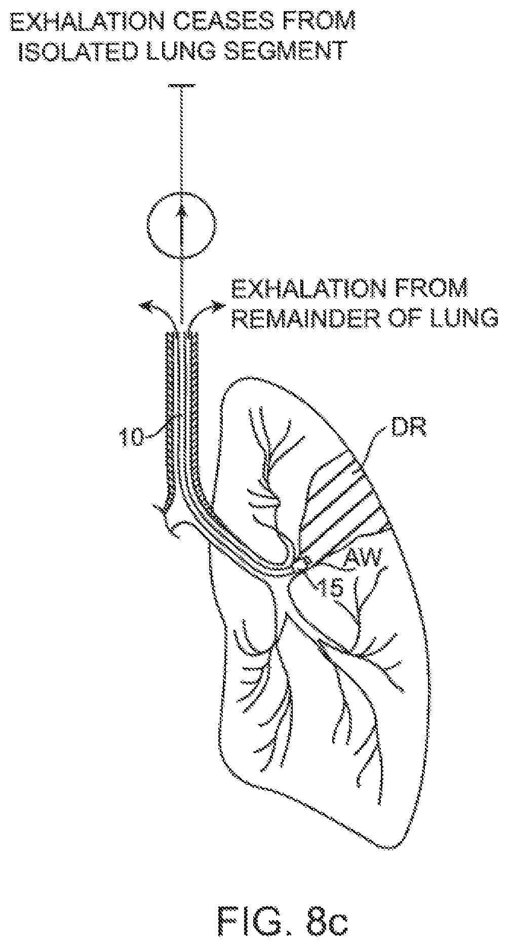 Patent US12350428 Figure 10 – Methods and devices for passive residual lung volume reduction and functional lung volume expansion