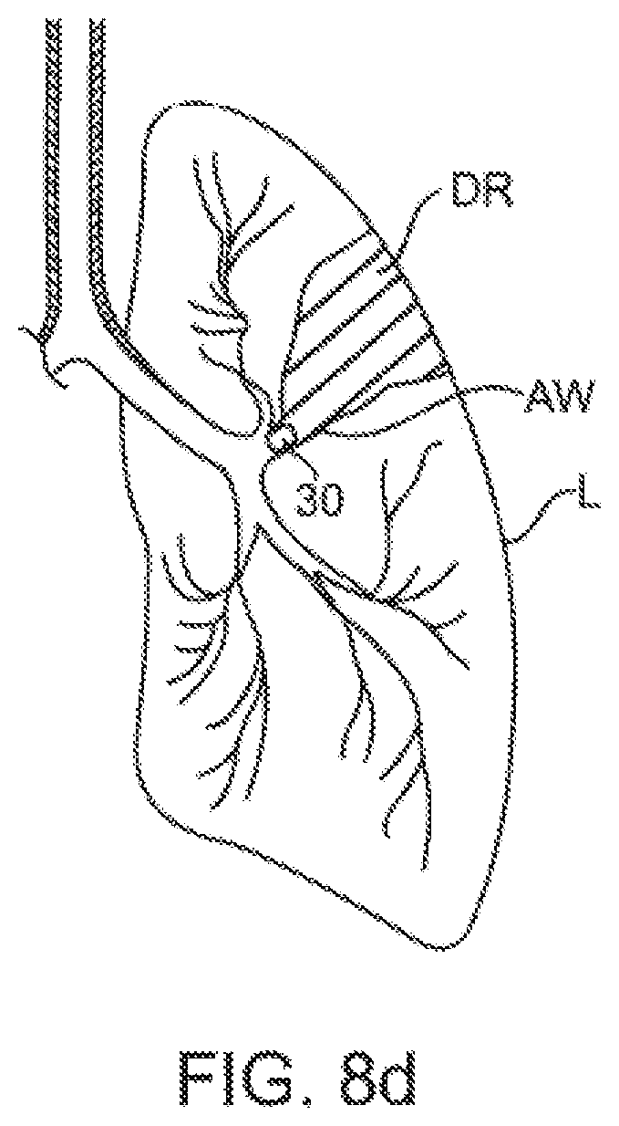Patent US12350428 Figure 11 – Methods and devices for passive residual lung volume reduction and functional lung volume expansion