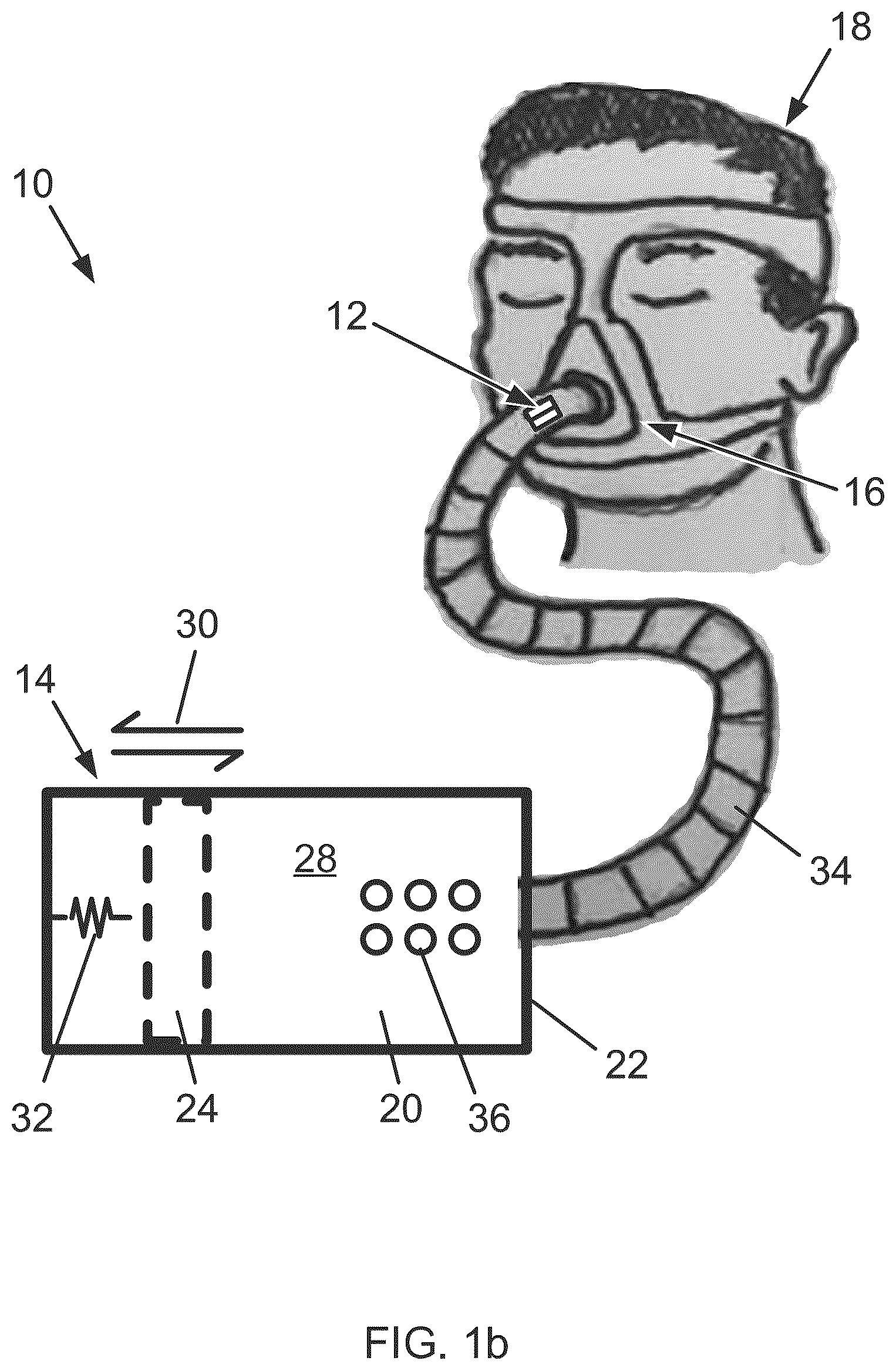 Patent US12350439 Figure 2 – Tuneable Expiratory Positive Airway Pressure (TEPAP) apparatus and method