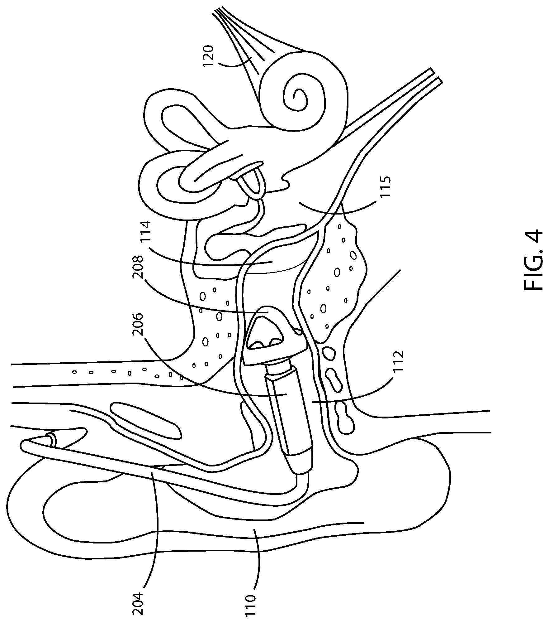 Patent US12350441 Figure 4 – Hearing assistance devices with motion sickness prevention and mitigation features