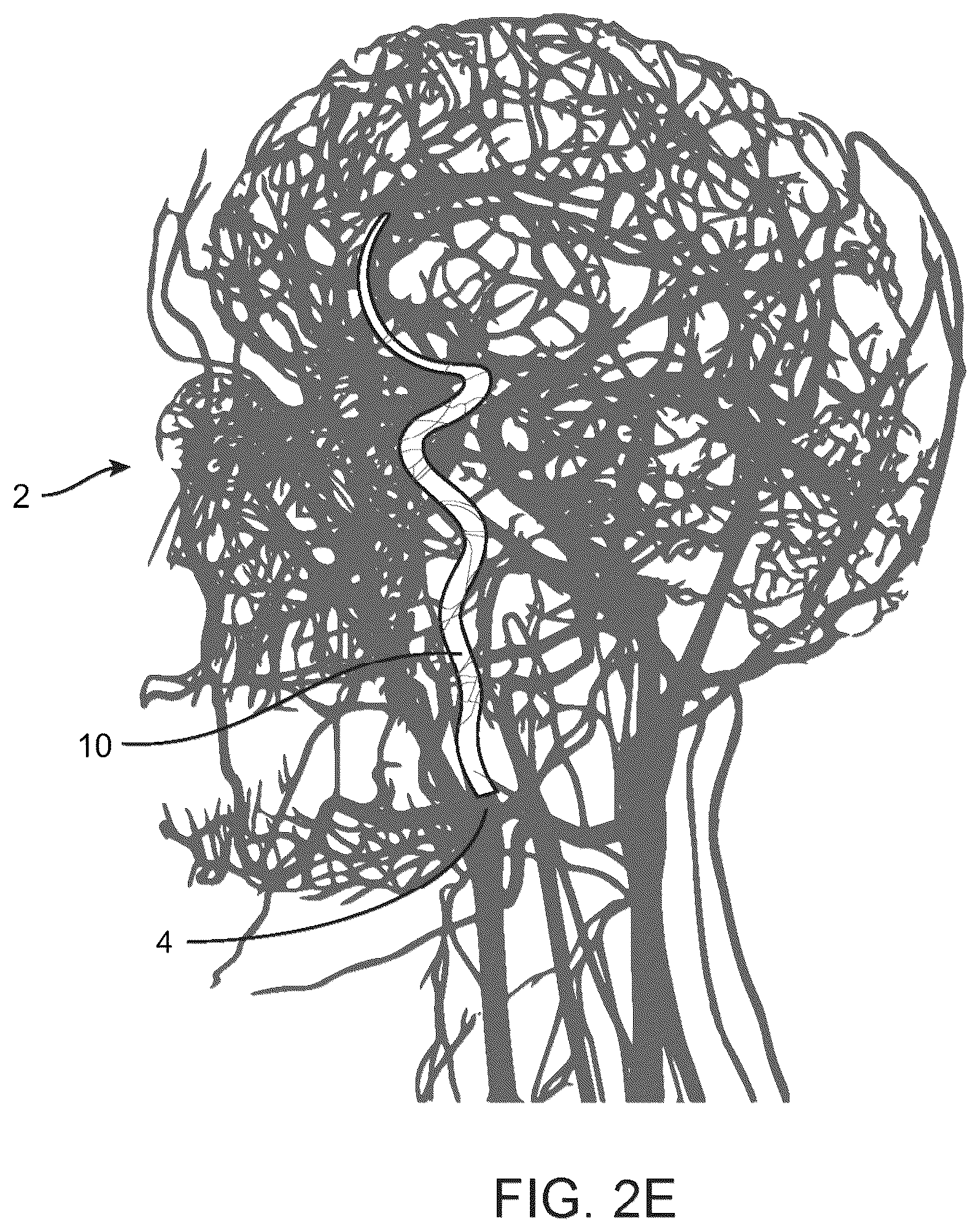 Patent US12350447 Figure 6 – Catheter construction