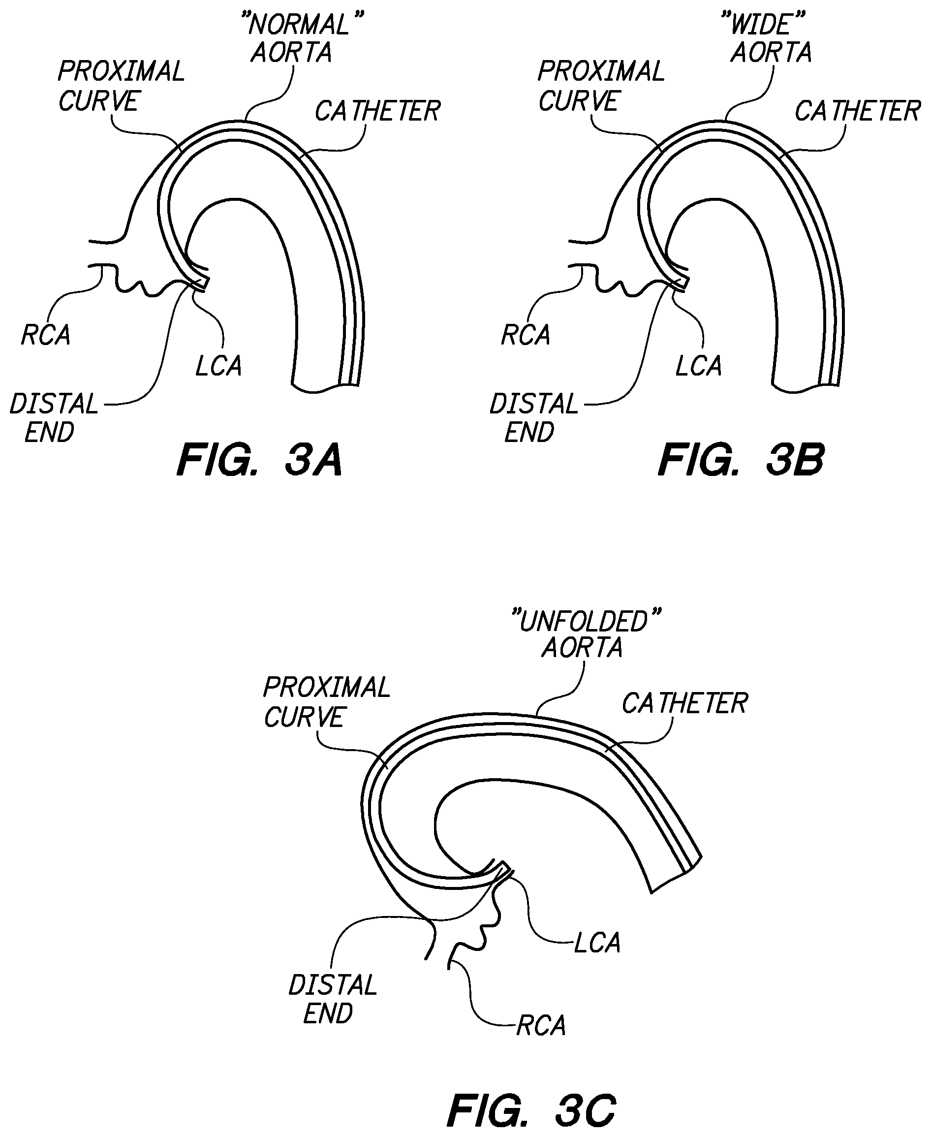 Patent US12350449 Figure 3 – Method of anchoring pullwire directly articulatable region in catheter