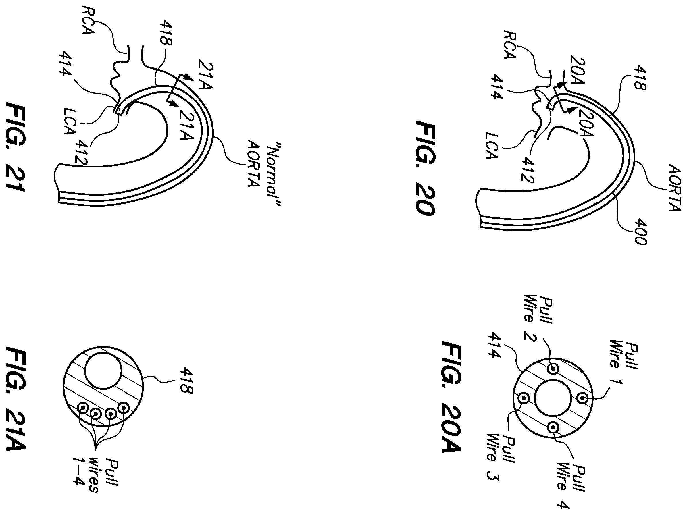 Patent US12350449 Figure 15 – Method of anchoring pullwire directly articulatable region in catheter