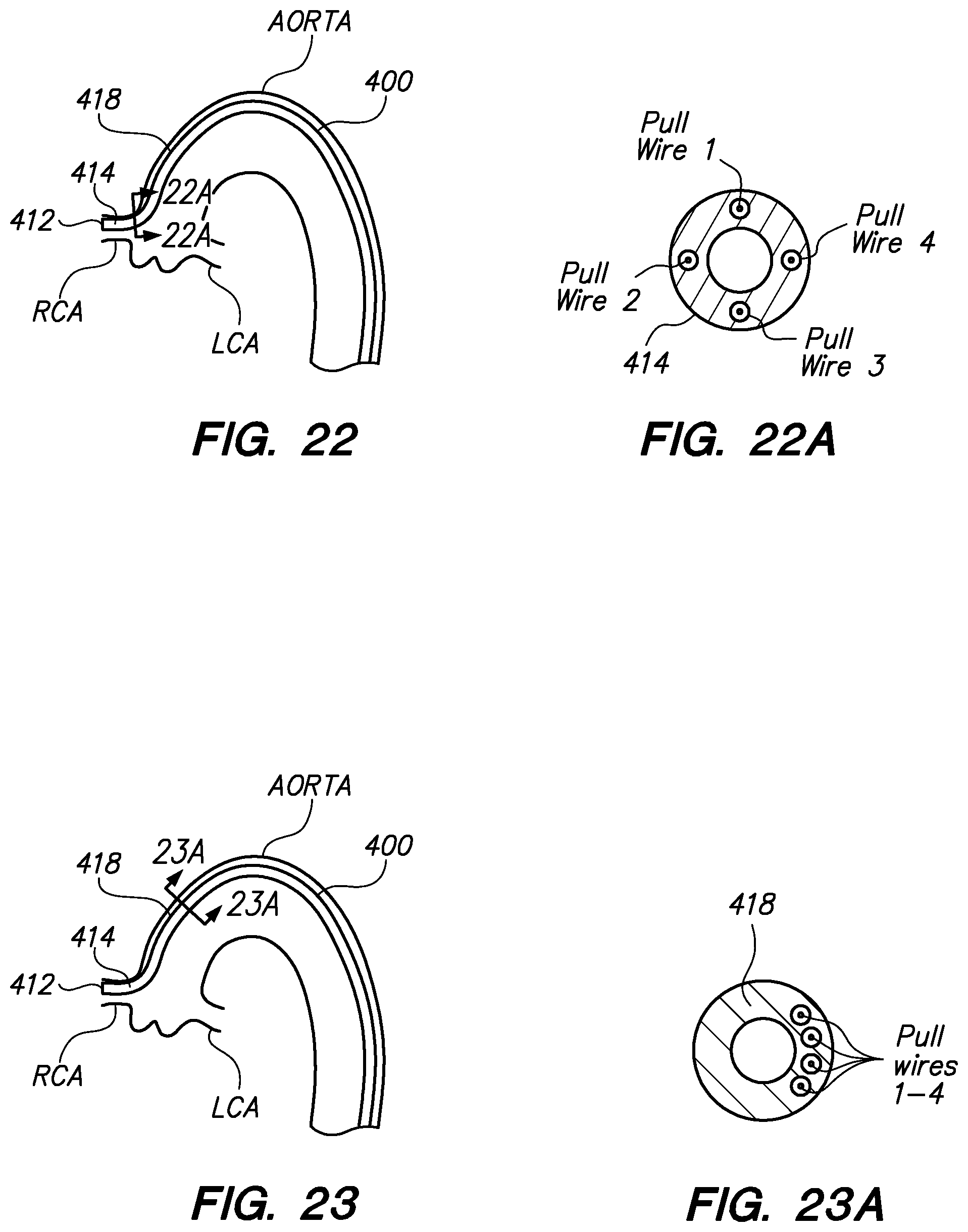 Patent US12350449 Figure 16 – Method of anchoring pullwire directly articulatable region in catheter