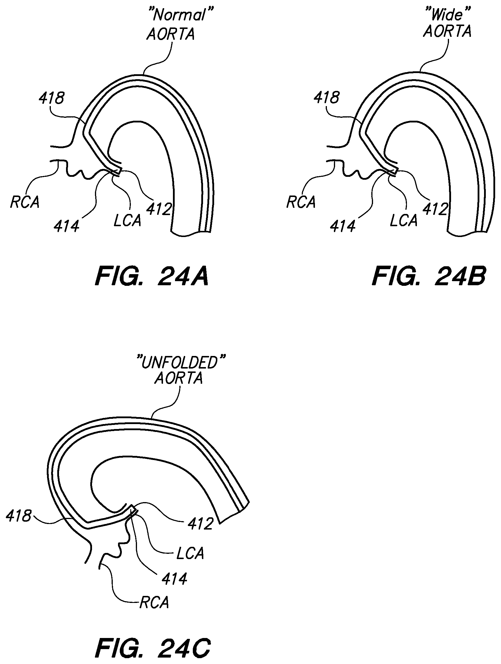 Patent US12350449 Figure 17 – Method of anchoring pullwire directly articulatable region in catheter