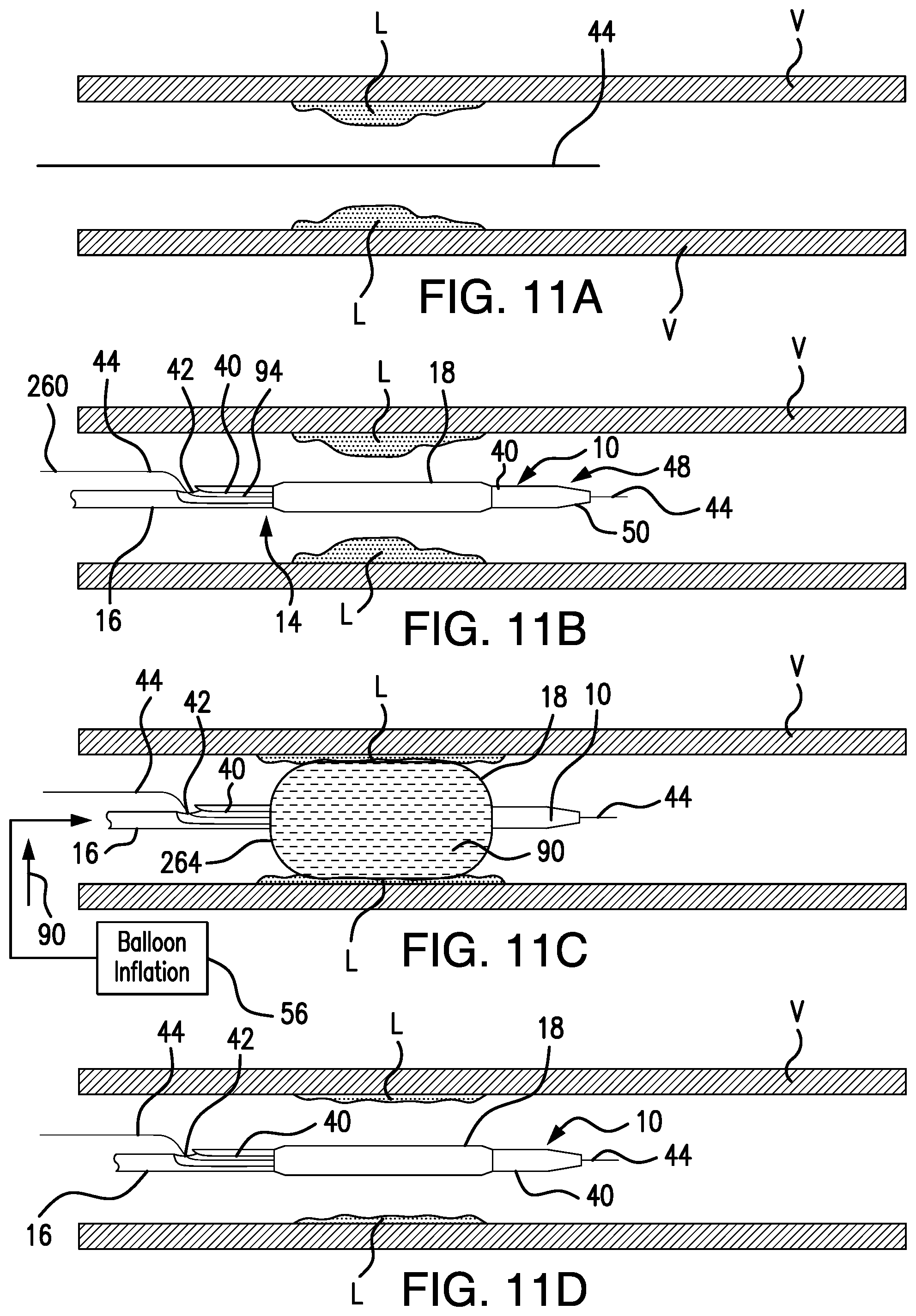 Patent US12350450 Figure 16 – System and method for controlled delivery of medical devices into patient bodies