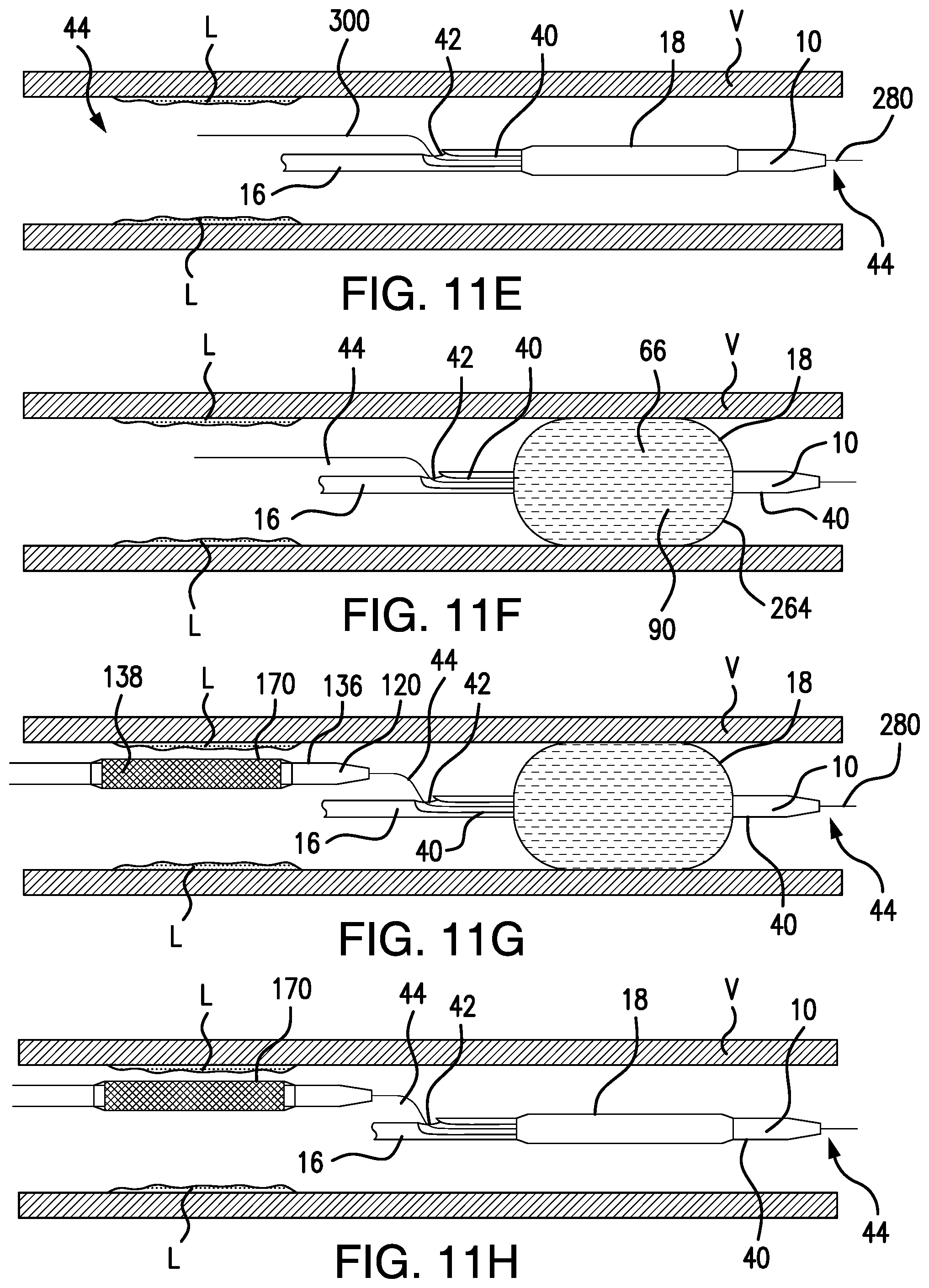 Patent US12350450 Figure 17 – System and method for controlled delivery of medical devices into patient bodies