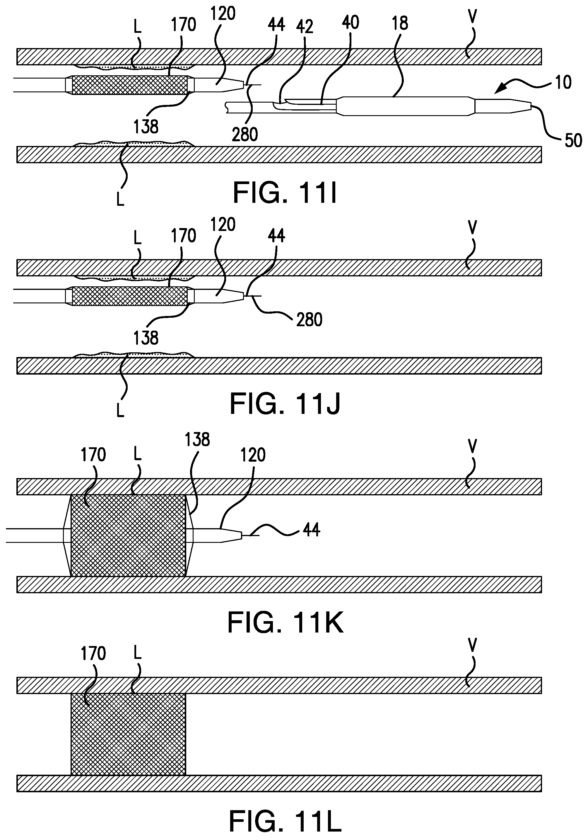 Patent US12350450 Figure 18 – System and method for controlled delivery of medical devices into patient bodies