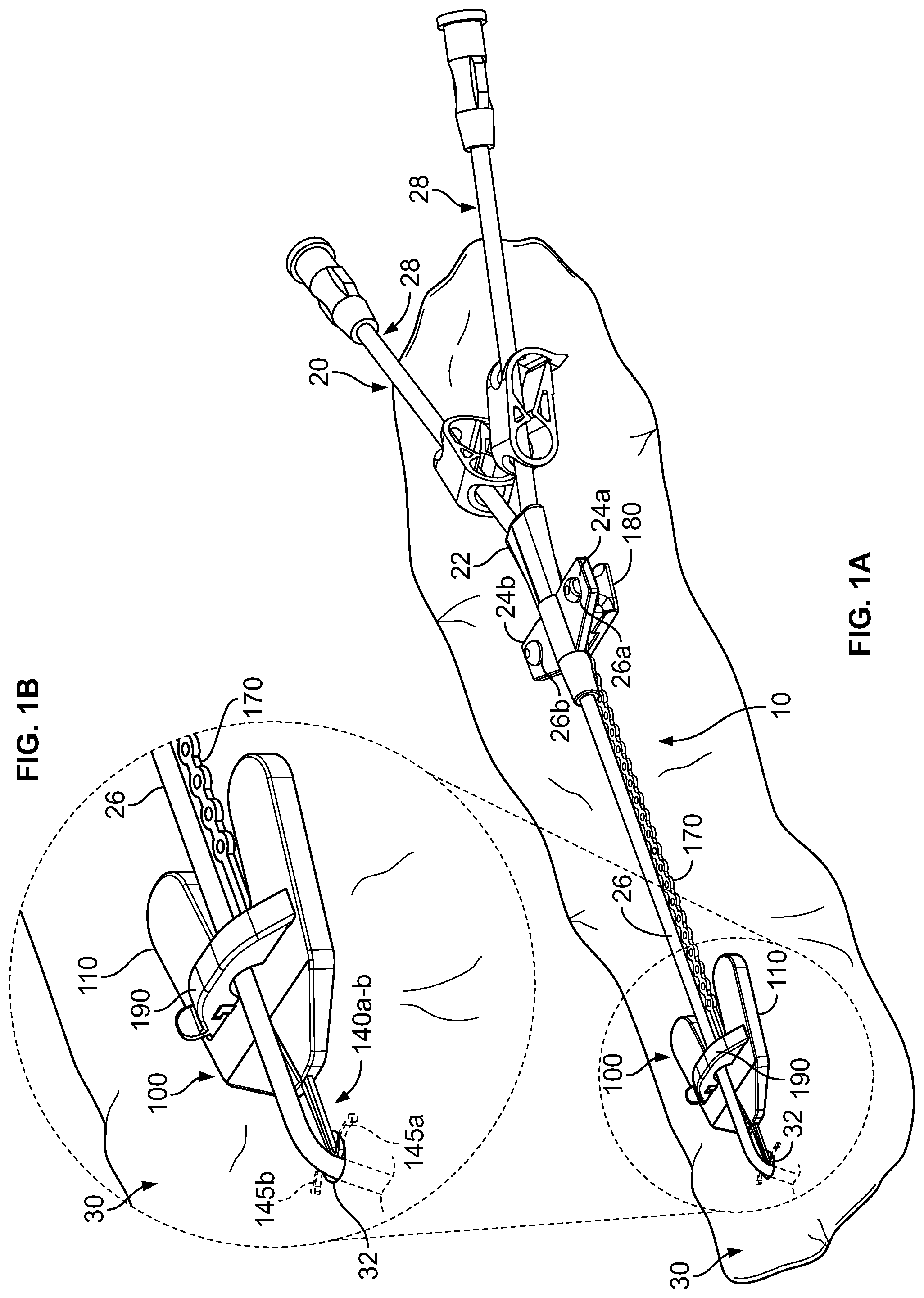 Patent US12350451 Figure 1 – Systems and methods for anchoring medical devices