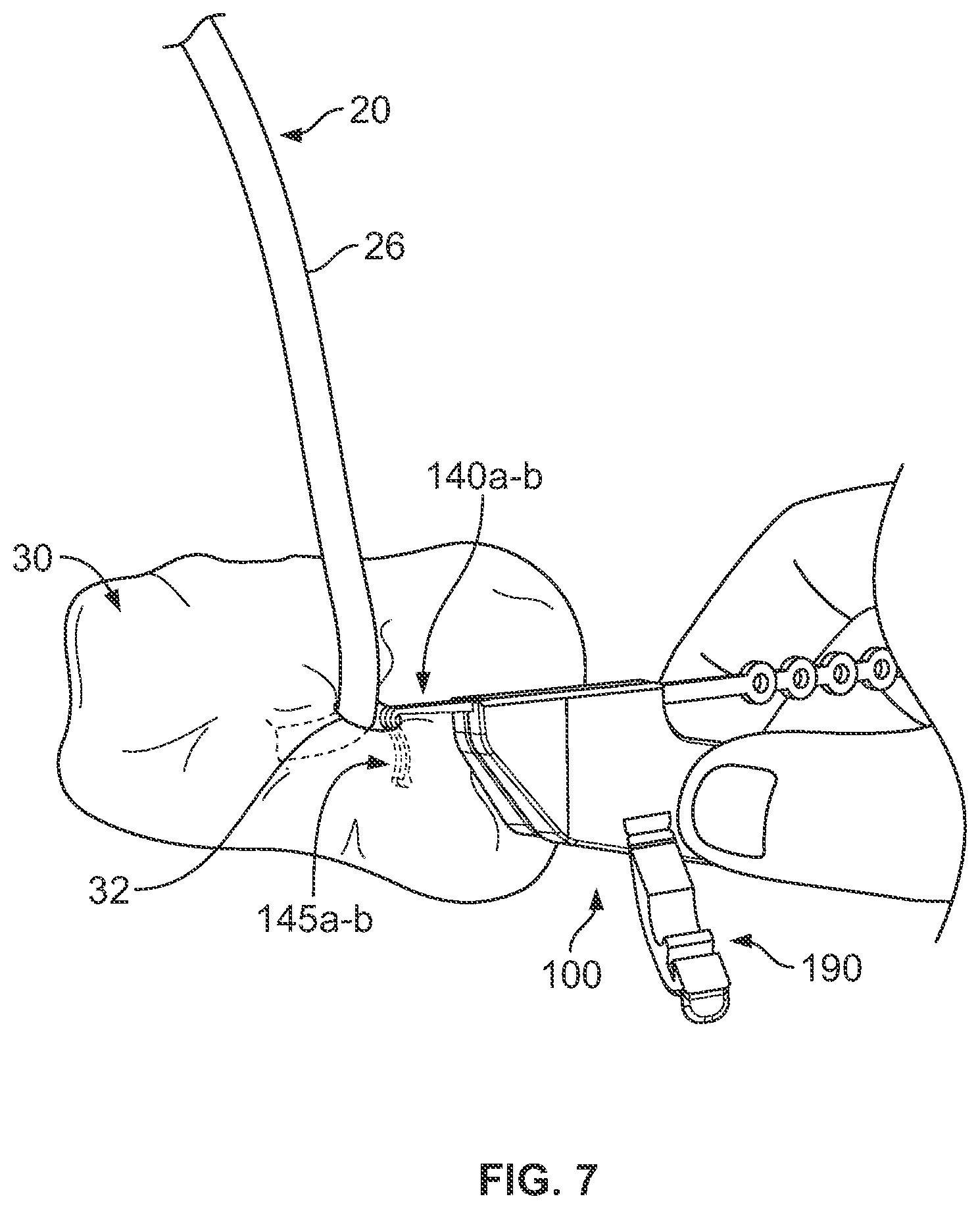 Patent US12350451 Figure 6 – Systems and methods for anchoring medical devices