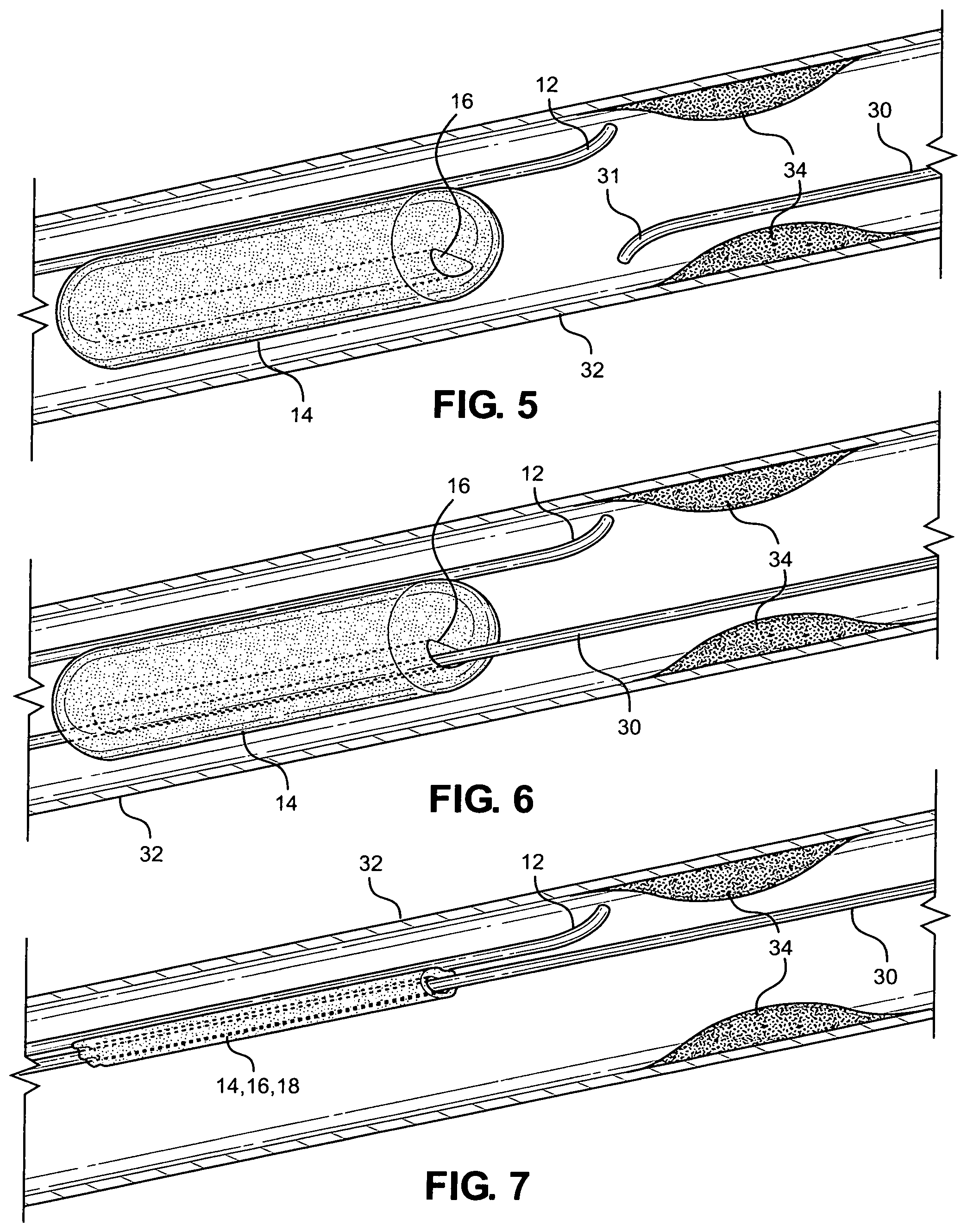 Patent US12350455 Figure 3 – Angioplasty balloon snare