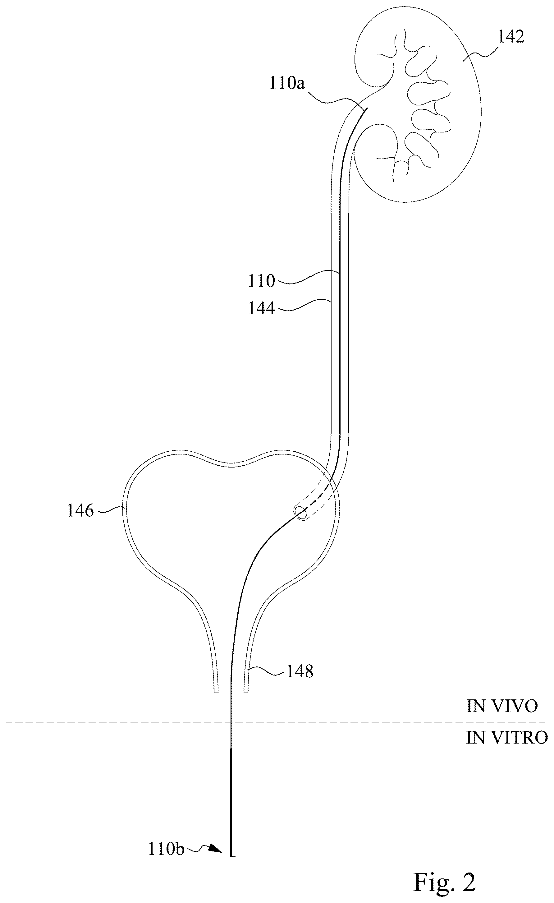 Patent US12350457 Figure 2 – Ureteral stent assembly and stent pusher thereof