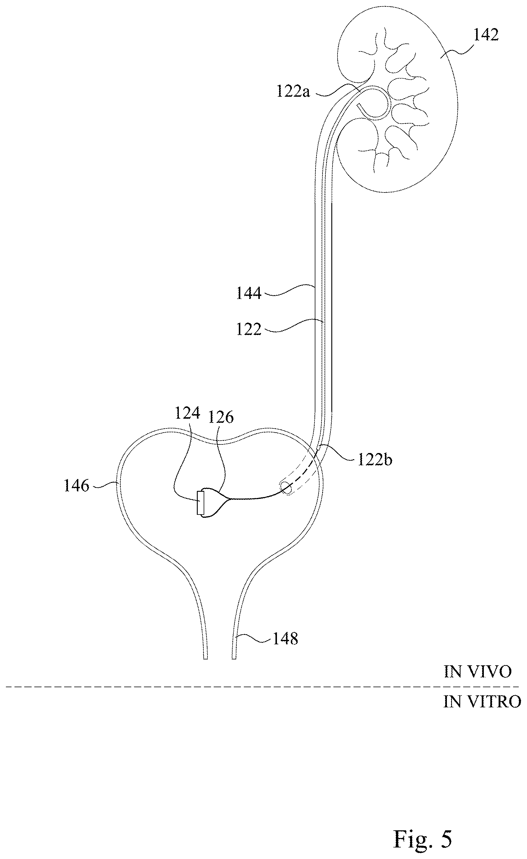 Patent US12350457 Figure 5 – Ureteral stent assembly and stent pusher thereof