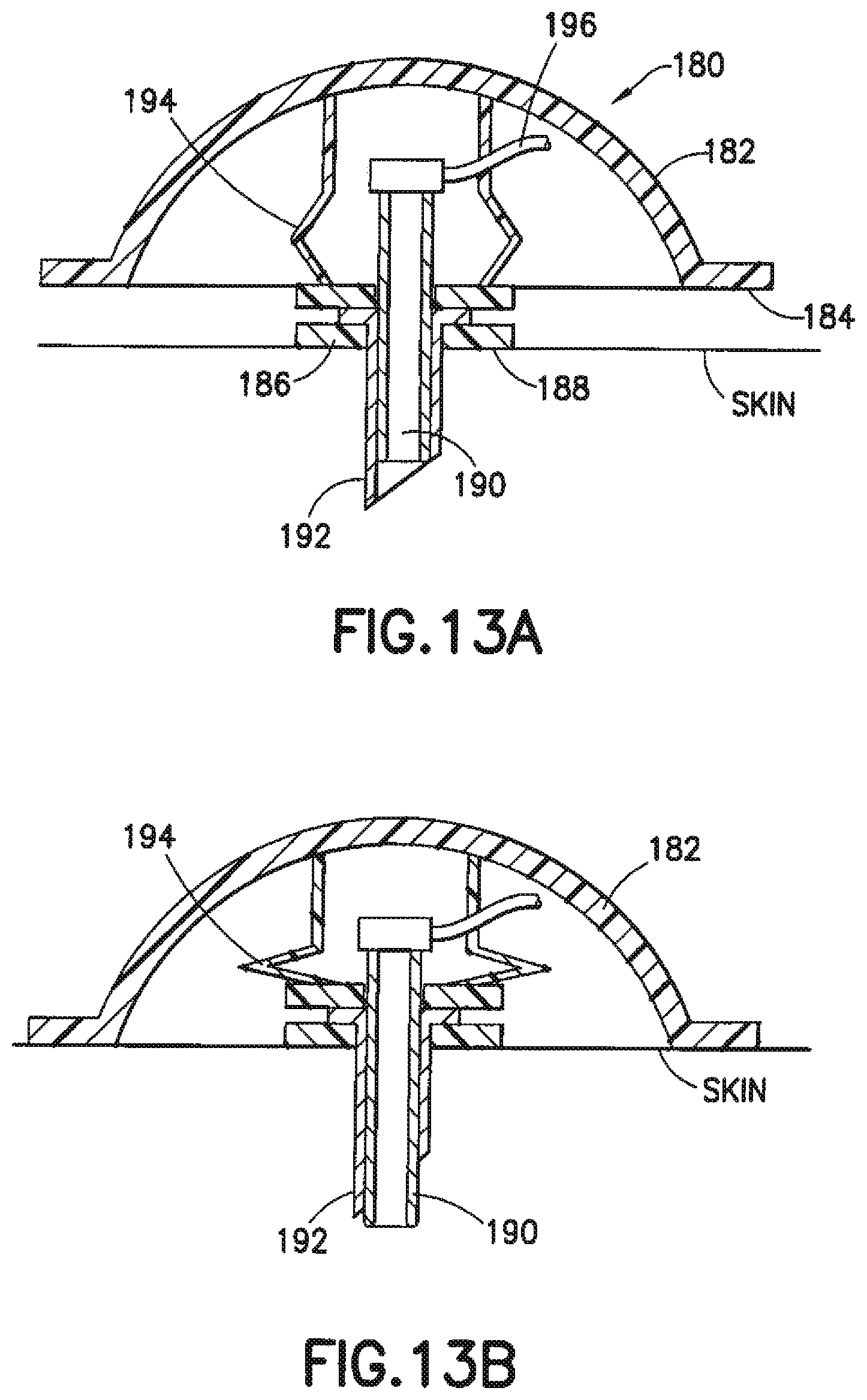 Patent US12350465 Figure 11 – Infusion set and/or patch pump having at least one of an in-dwelling rigid catheter with flexible features and/or a flexible catheter attachment