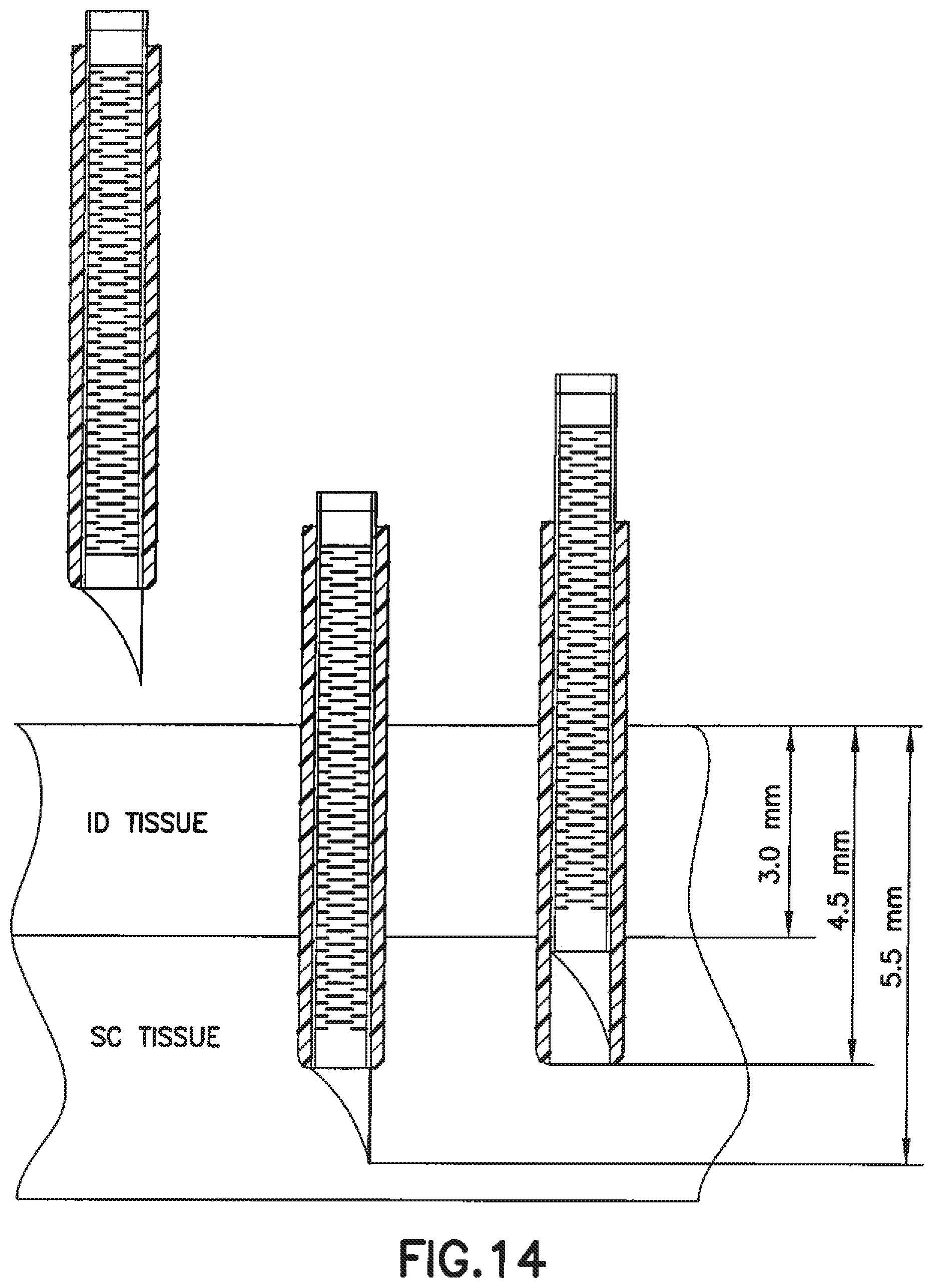 Patent US12350465 Figure 12 – Infusion set and/or patch pump having at least one of an in-dwelling rigid catheter with flexible features and/or a flexible catheter attachment