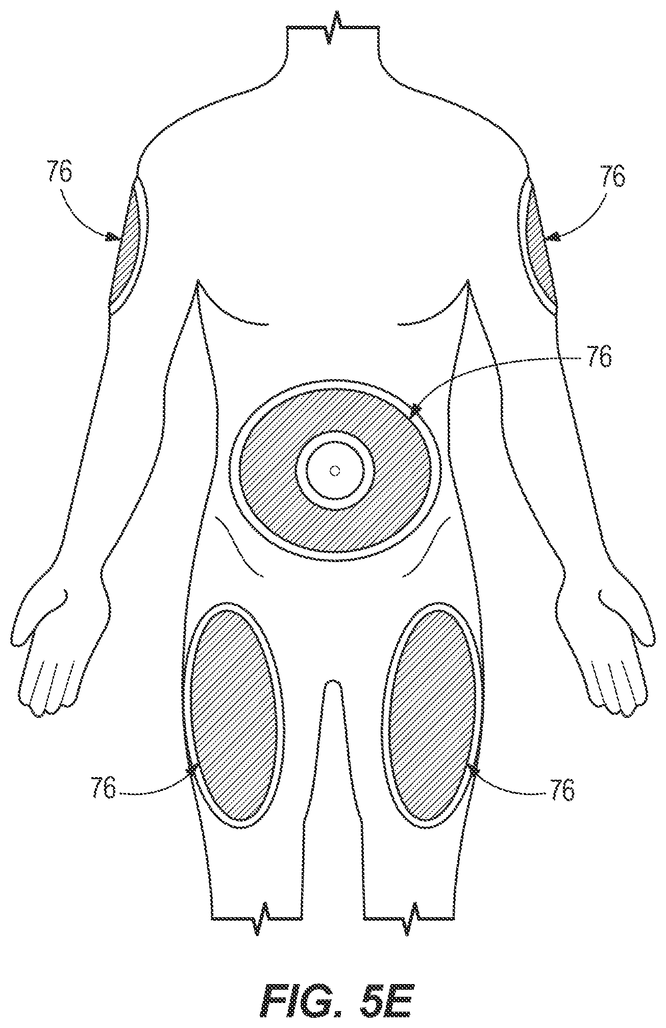 Patent US12350475 Figure 5 – Method of injecting octreotide acetate into the body