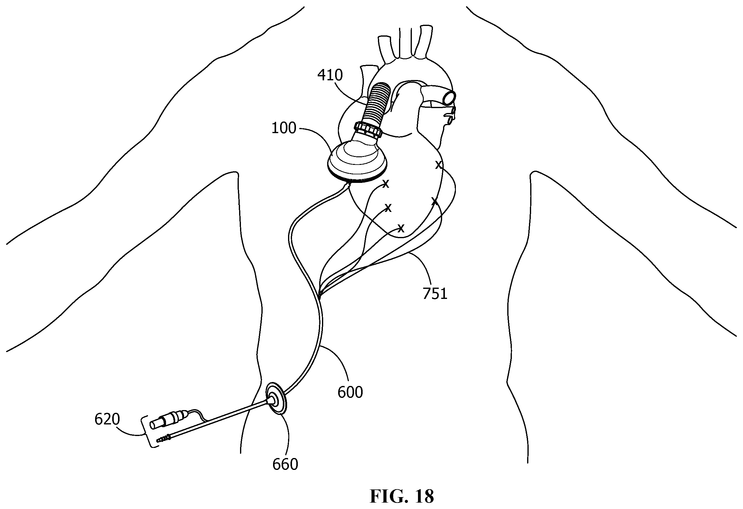 Patent US12350481 Figure 8 – Pressure unloading left ventricular assist device and methods for assisting a human heart