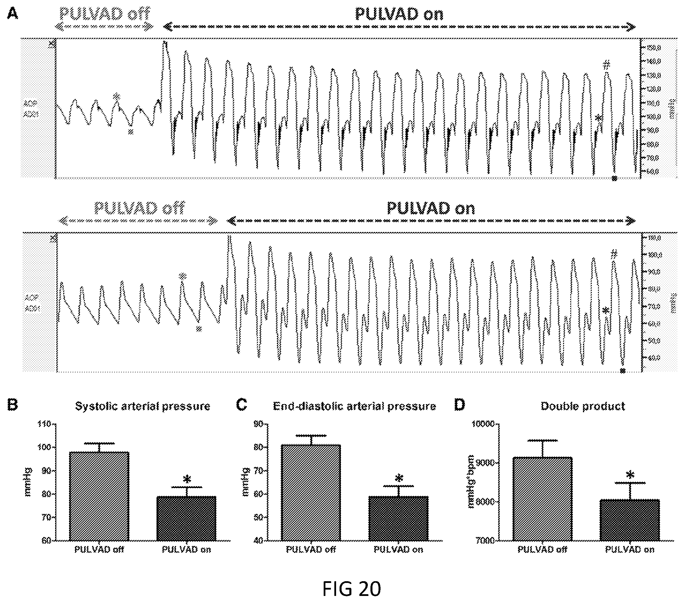 Patent US12350481 Figure 10 – Pressure unloading left ventricular assist device and methods for assisting a human heart