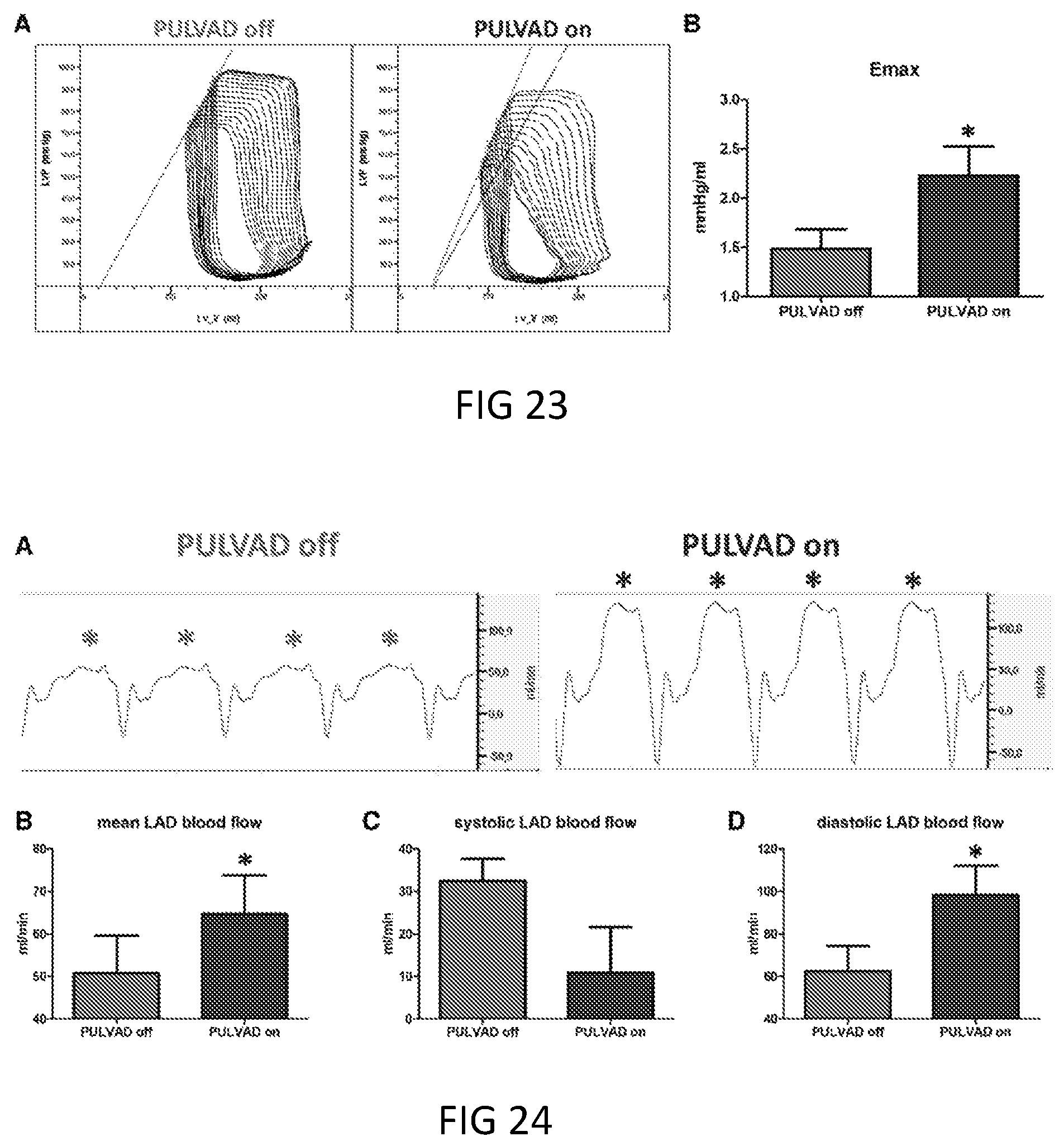 Patent US12350481 Figure 13 – Pressure unloading left ventricular assist device and methods for assisting a human heart
