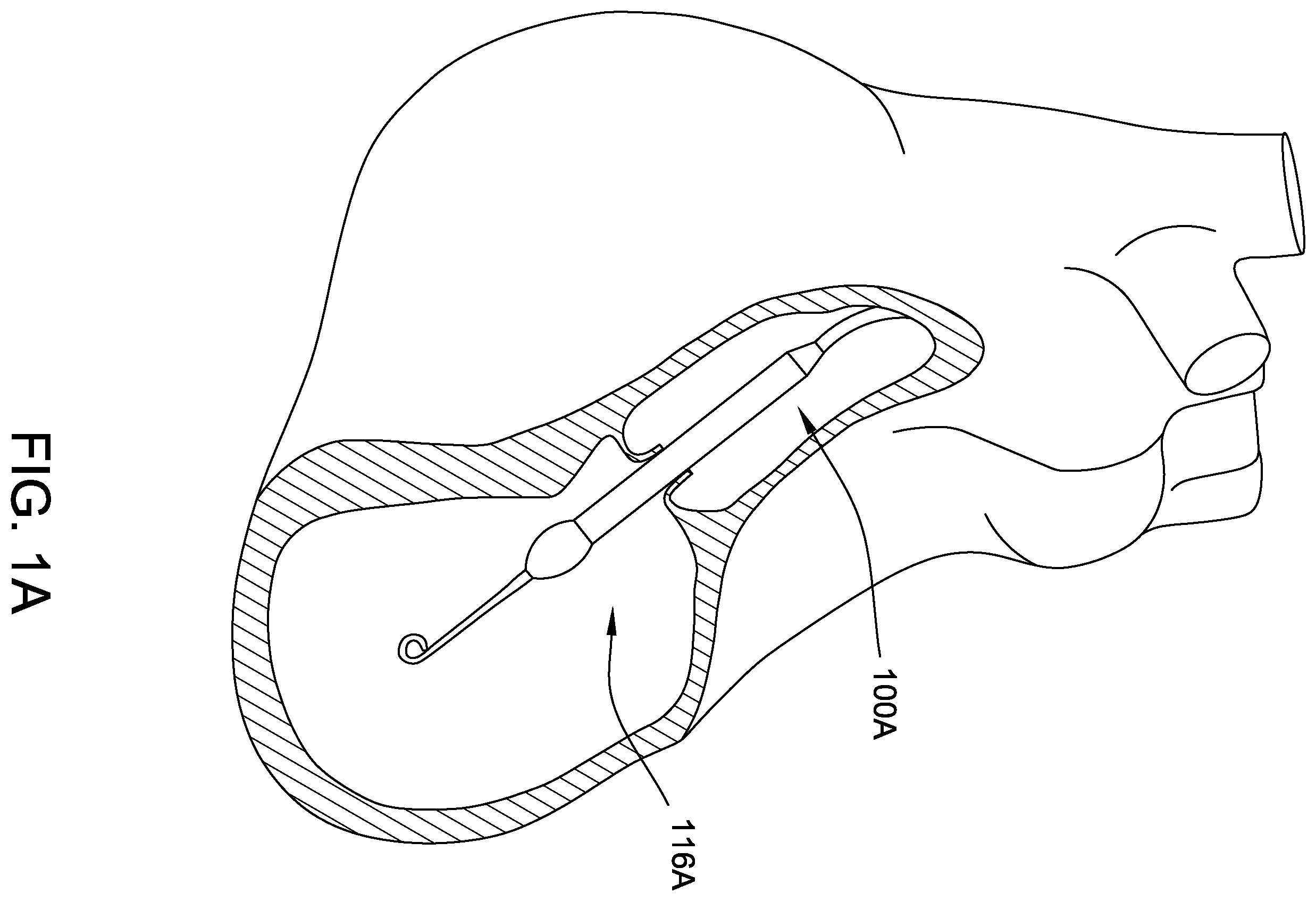Patent US12350483 Figure 1 – Fluid seals for catheter pump motor assembly
