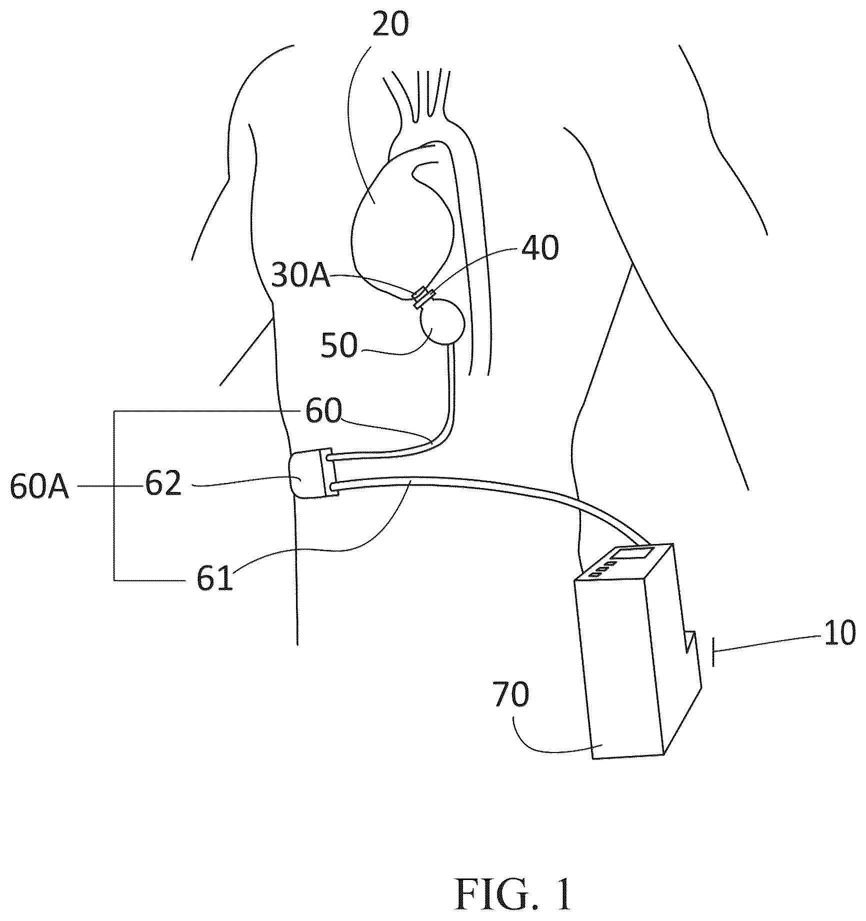 Patent US12350484 Figure 1 – Implantable co-pulsatile epi-ventricular circulatory support system with sutureless flow cannula assembly