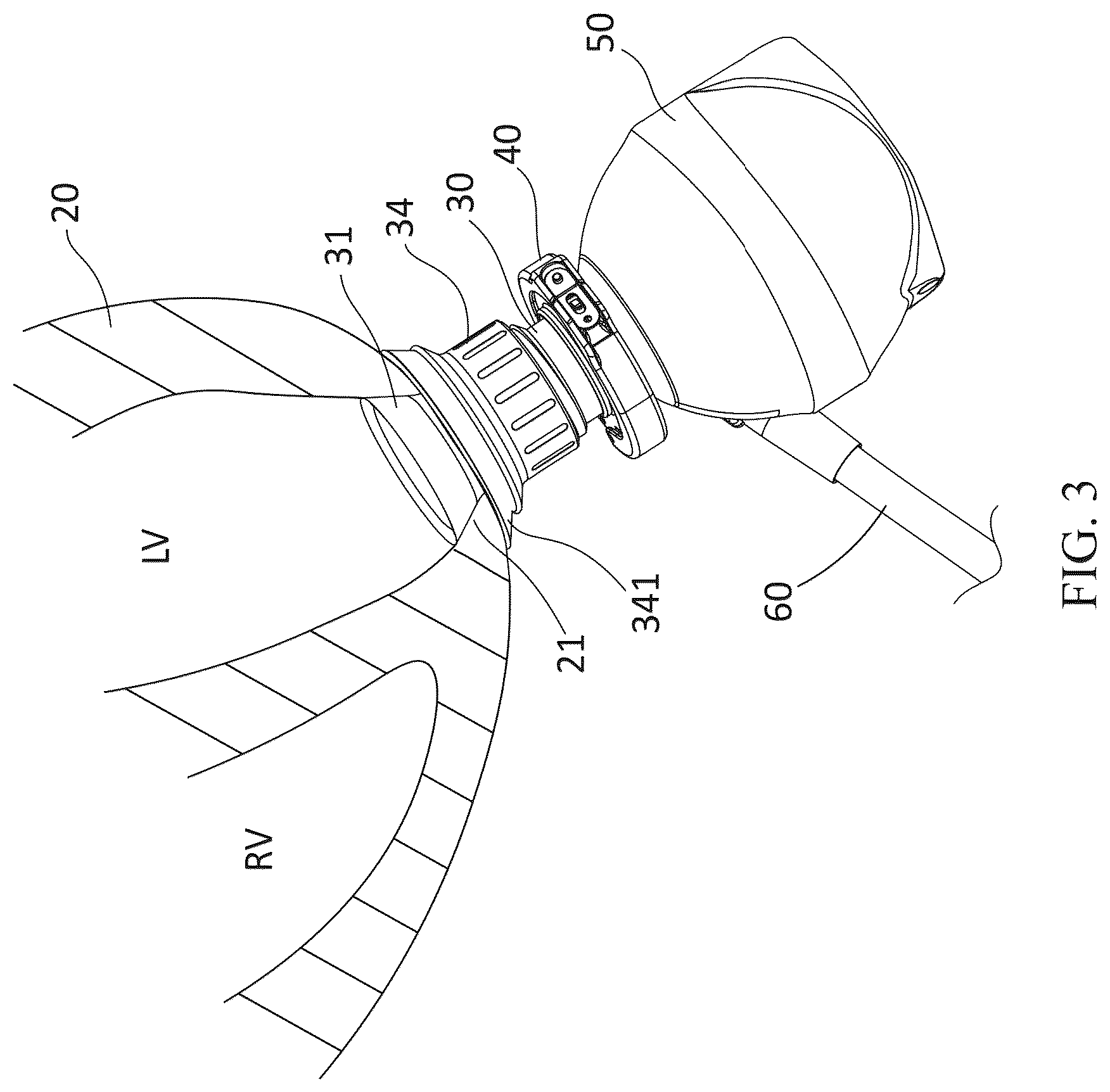 Patent US12350484 Figure 3 – Implantable co-pulsatile epi-ventricular circulatory support system with sutureless flow cannula assembly