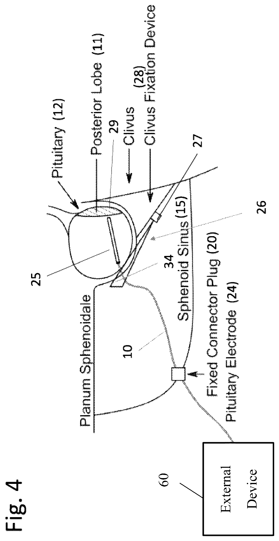 Patent US12350488 Figure 4 – System and method for intermittent electrical modulation