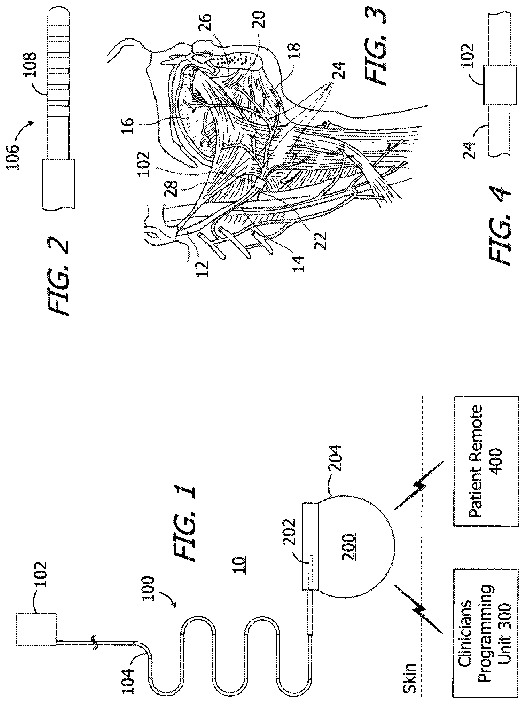 Patent US12350489 Figure 1 – Electrode leads having nerve cuffs and associated systems and methods