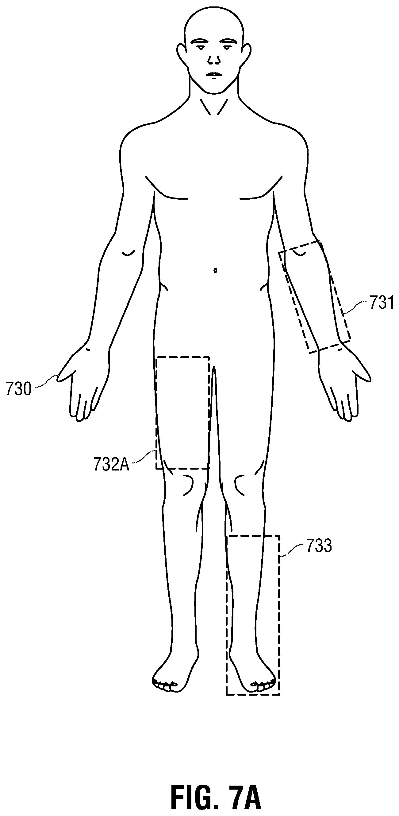 Patent US12350490 Figure 7 – Electrotherapy glove for delivery of amplitude modulated pulsed direct current during manual therapy treatment