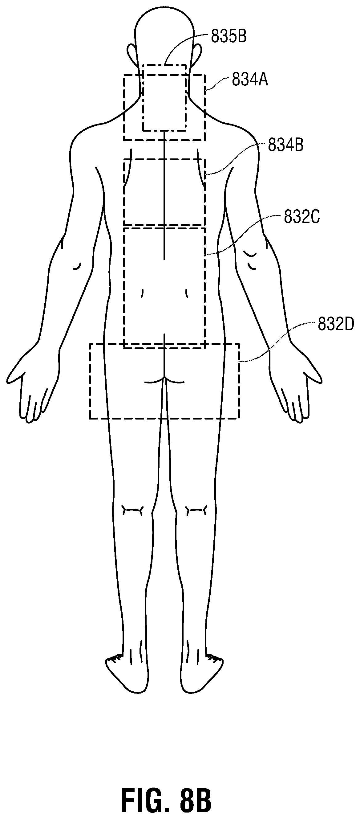 Patent US12350490 Figure 10 – Electrotherapy glove for delivery of amplitude modulated pulsed direct current during manual therapy treatment