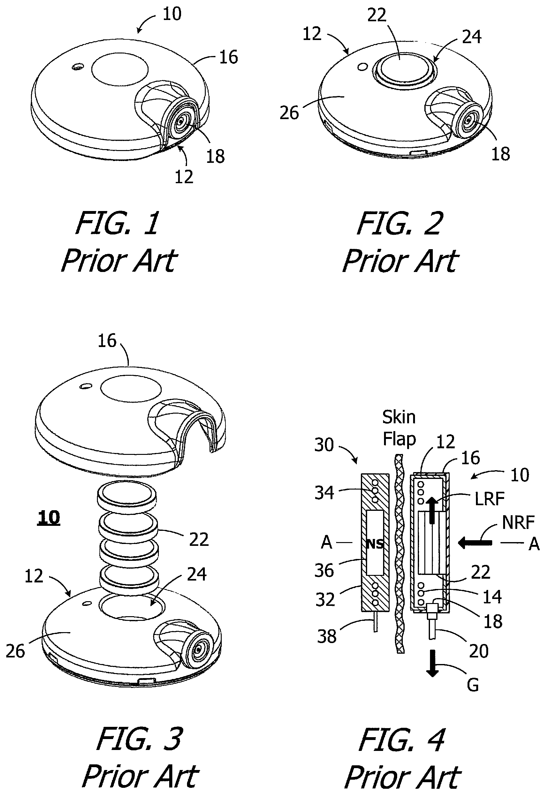 Patent US12350493 Figure 1 – Headpieces and implantable cochlear stimulation systems including the same