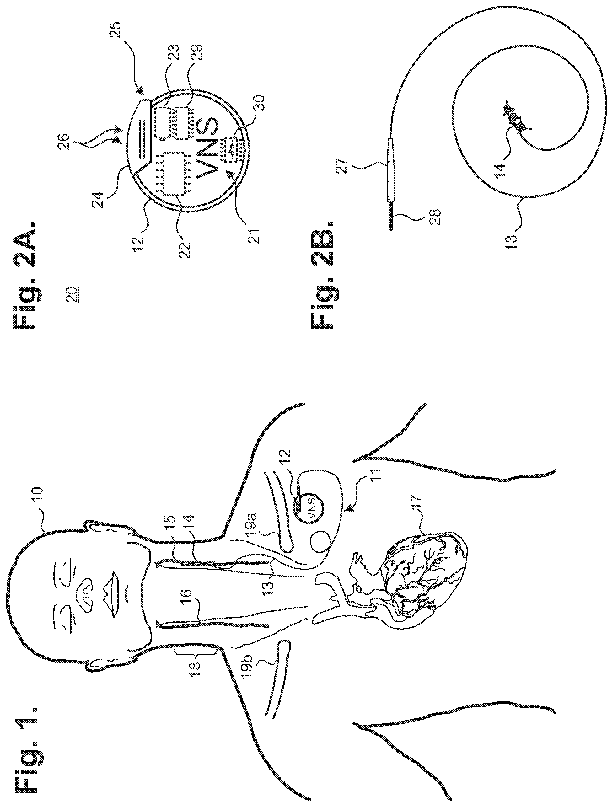 Patent US12350496 Figure 1 – Implantable neurostimulator-implemented method for managing bradycardia through vagus nerve stimulation