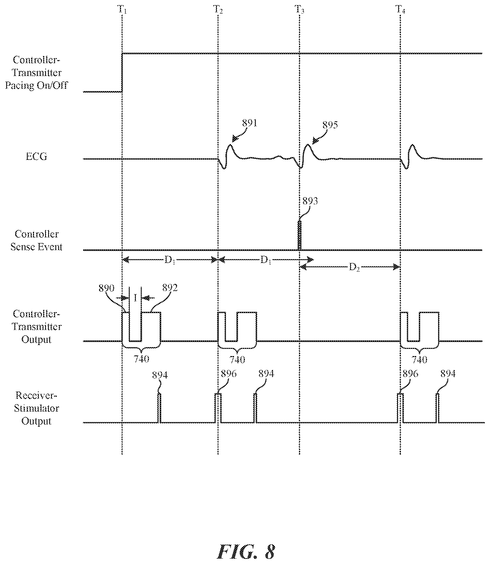 Patent US12350497 Figure 7 – Tissue stimulation systems and methods, such as for pacing cardiac tissue