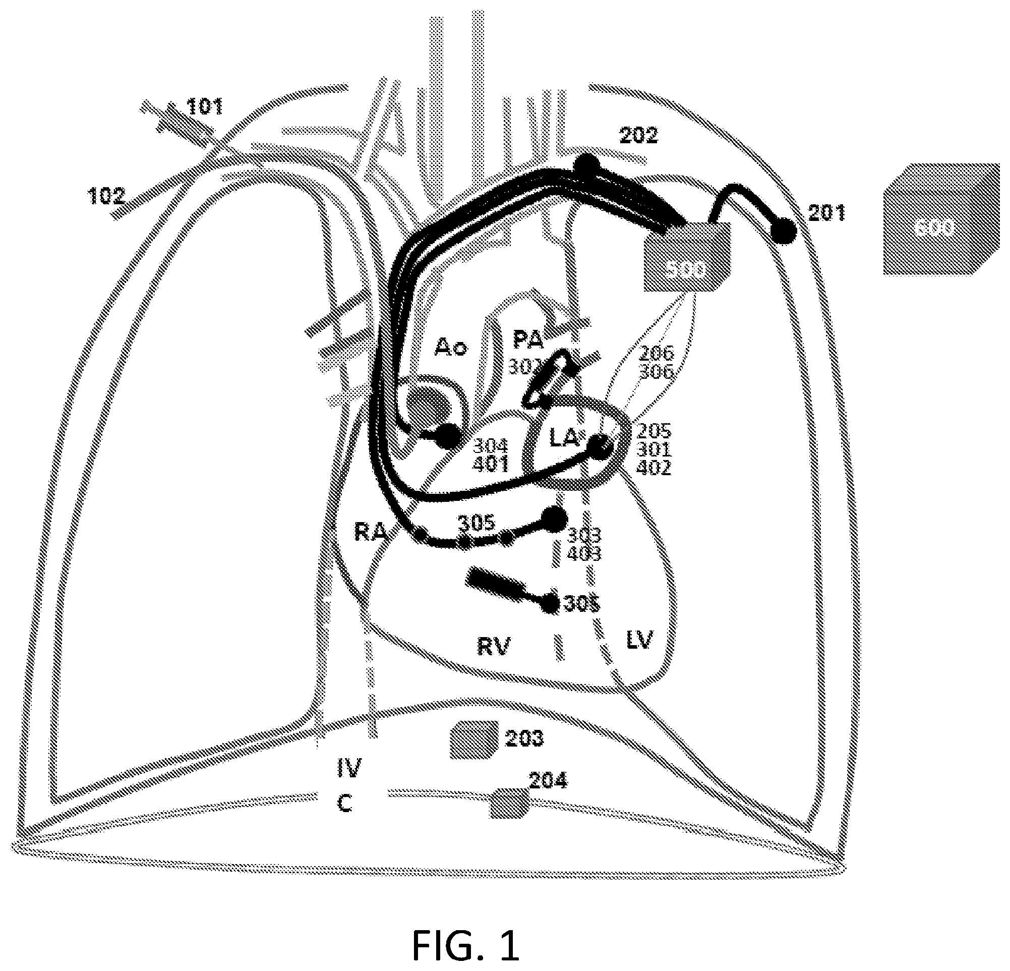 Patent US12350498 Figure 1 – Treatment of cardiac decompensation, pulmonary congestion and dyspnea