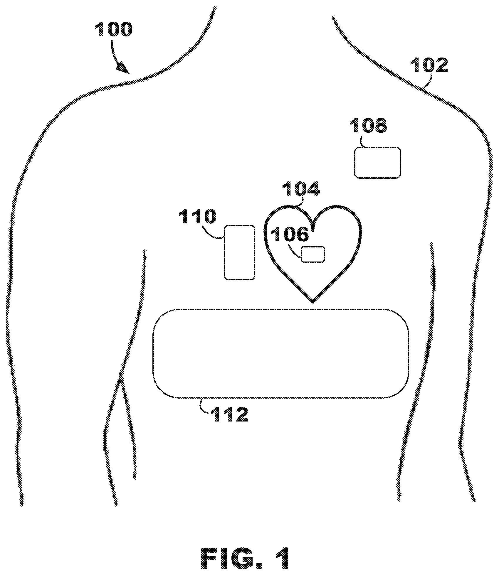 Patent US12350500 Figure 1 – AV synchronous septal pacing