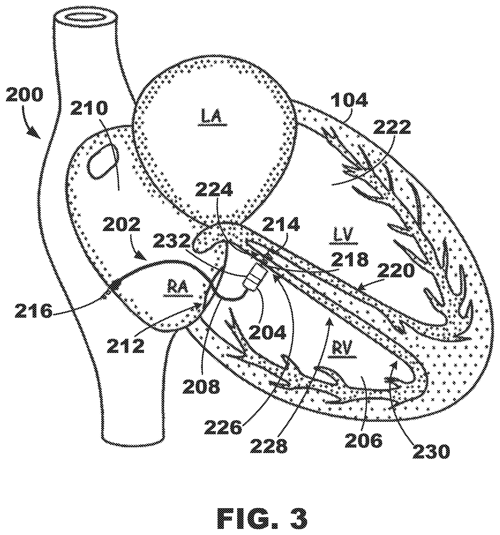 Patent US12350500 Figure 3 – AV synchronous septal pacing