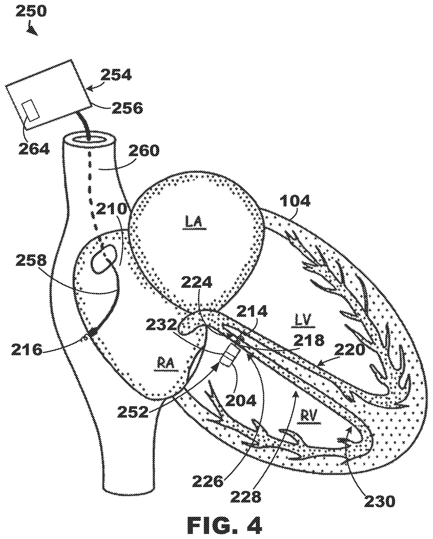 Patent US12350500 Figure 4 – AV synchronous septal pacing